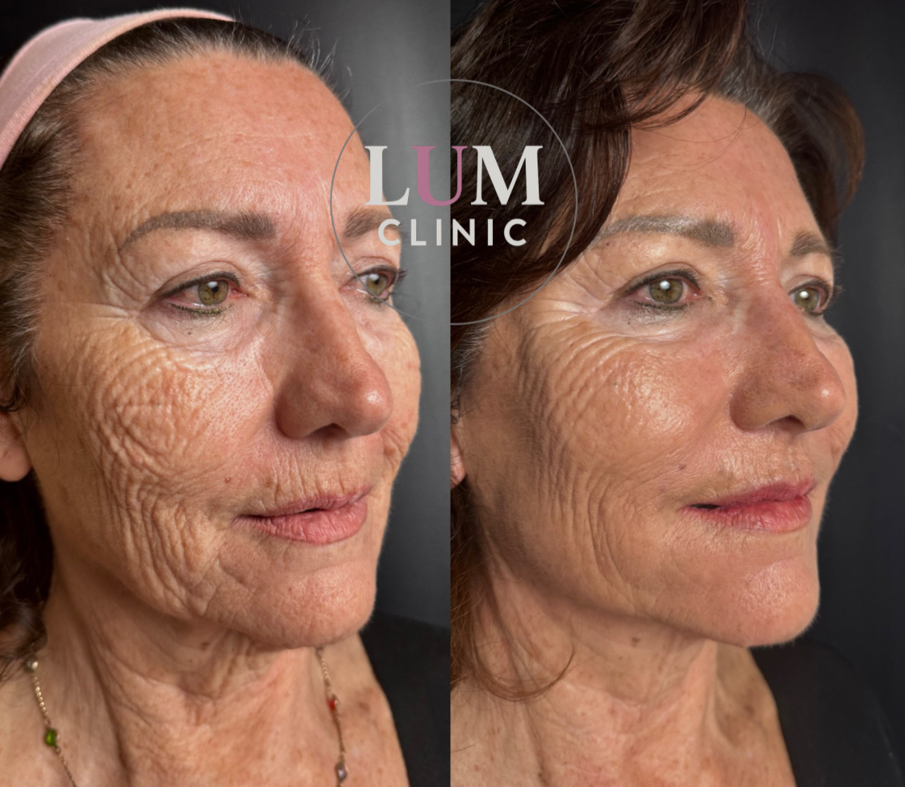 Antes y despues - Rejuvenecimiento facial