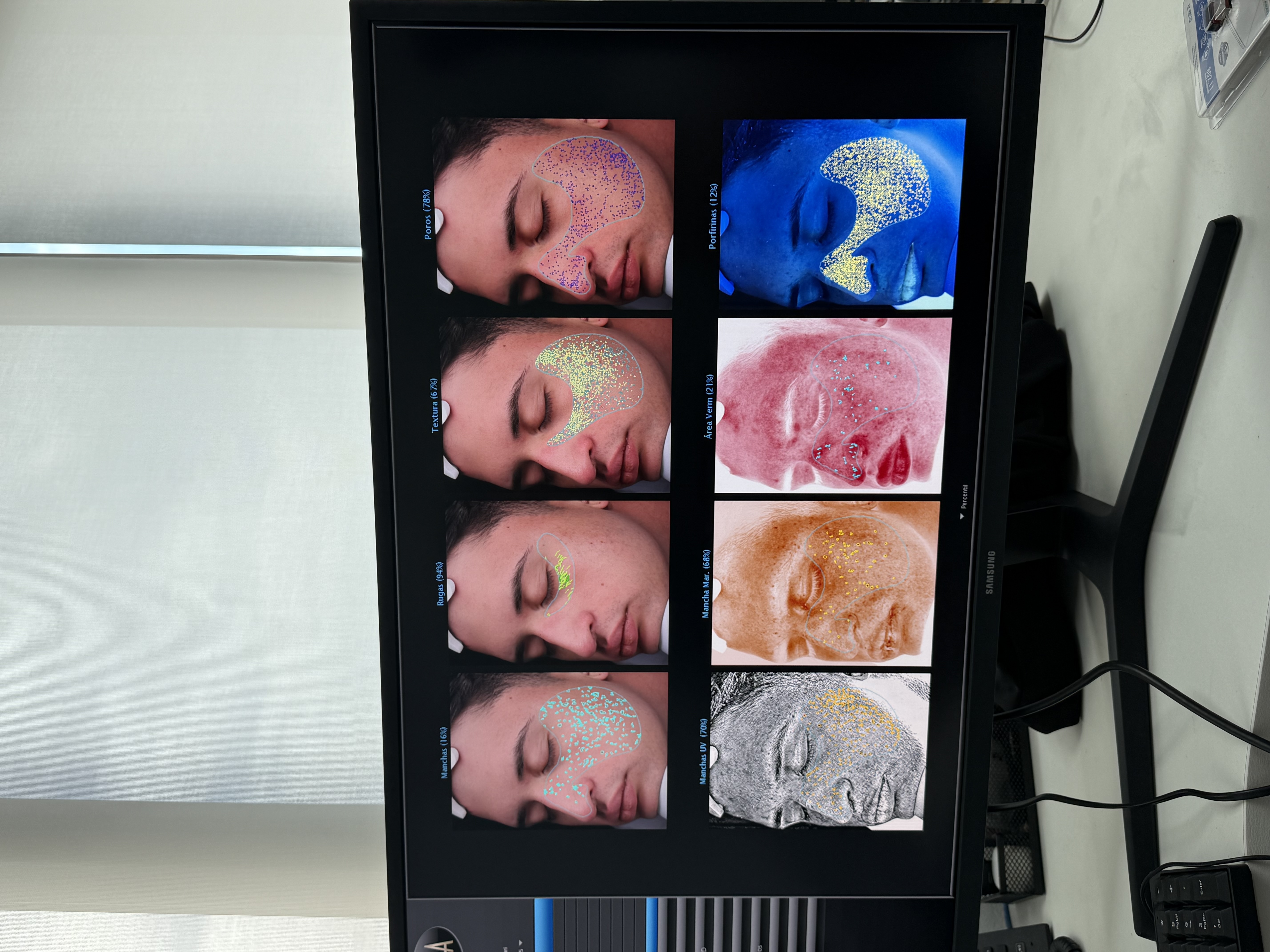 Monitor de analise Visia em ambiente clinico mostrando avaliacao multiparametrica do paciente