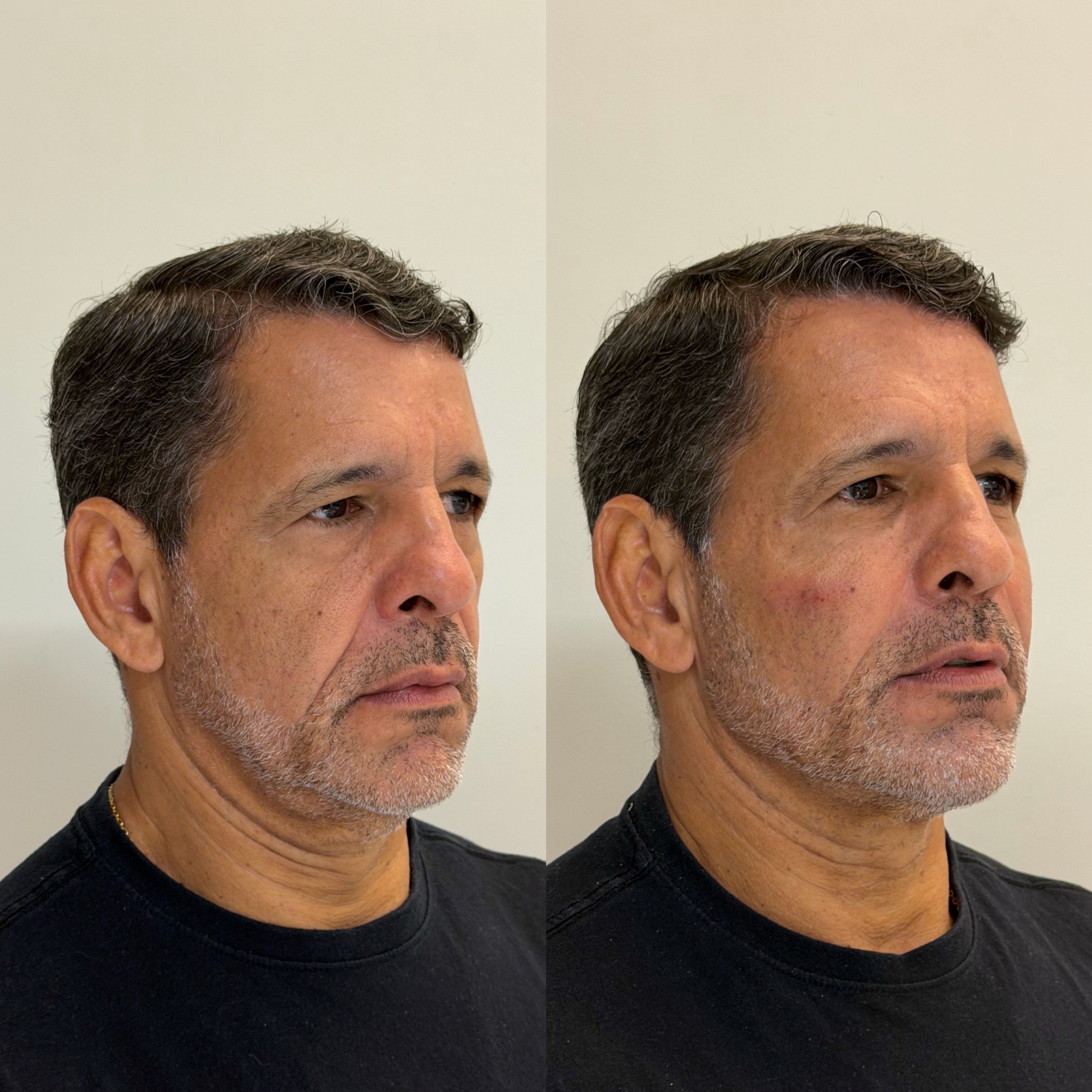 Resultado após tratamento