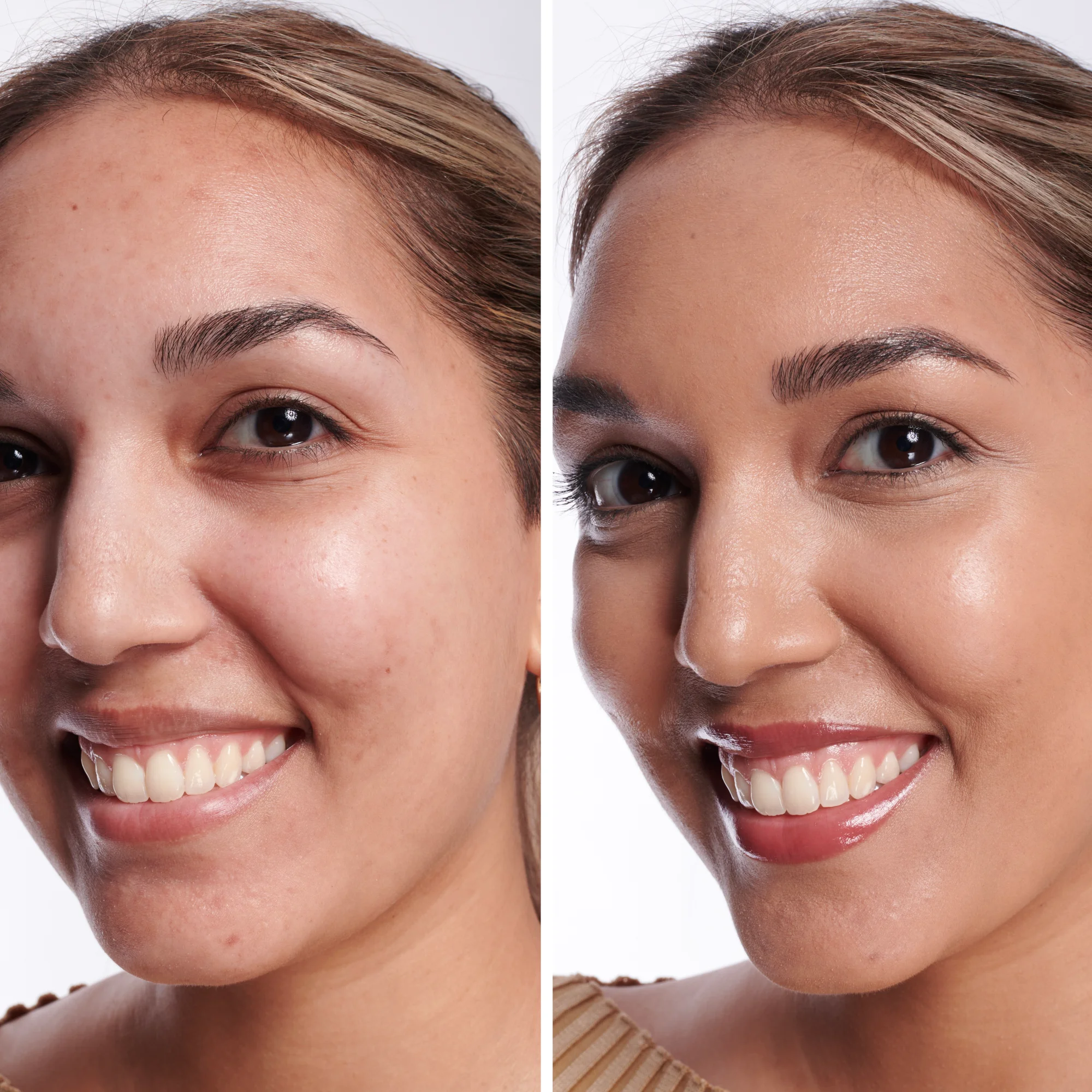 Before dark spots treatment showing visible spots and uneven skin tone
