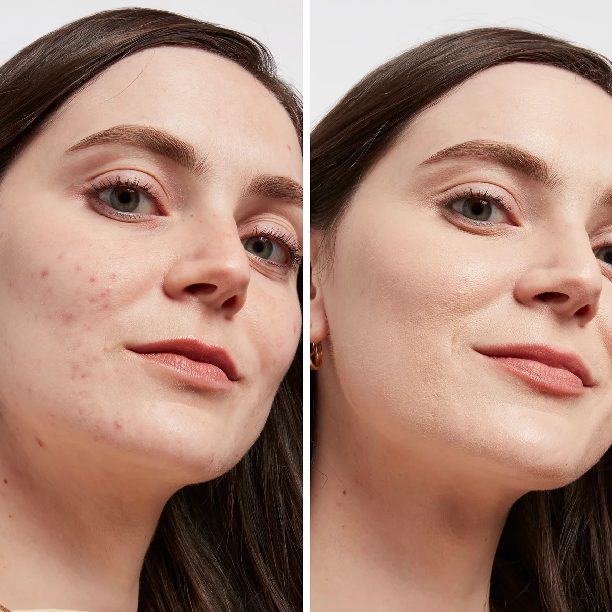 Before and after comparison showing dark spots treatment results