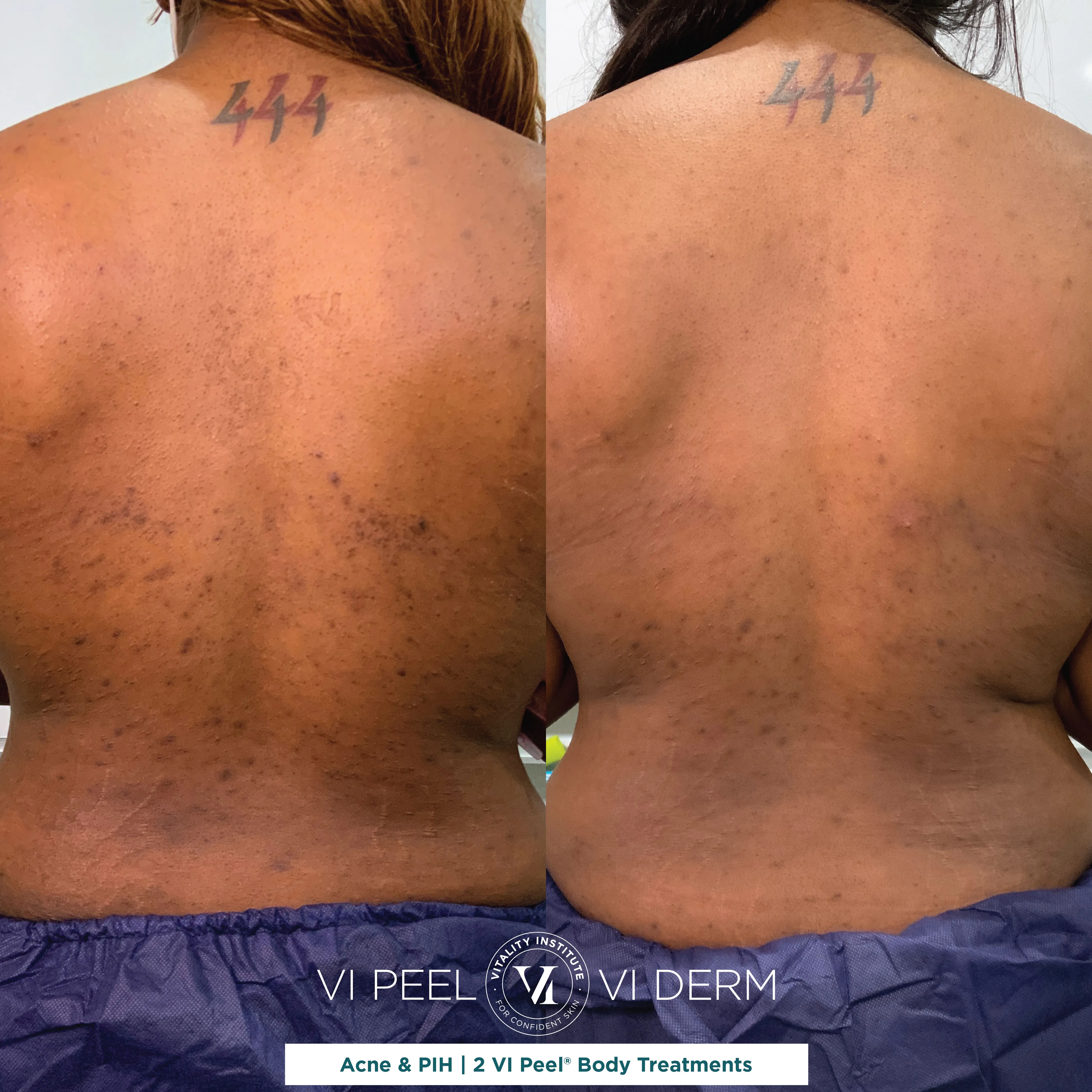 Back Acne & PIH — 2 VI Peel Body Treatments