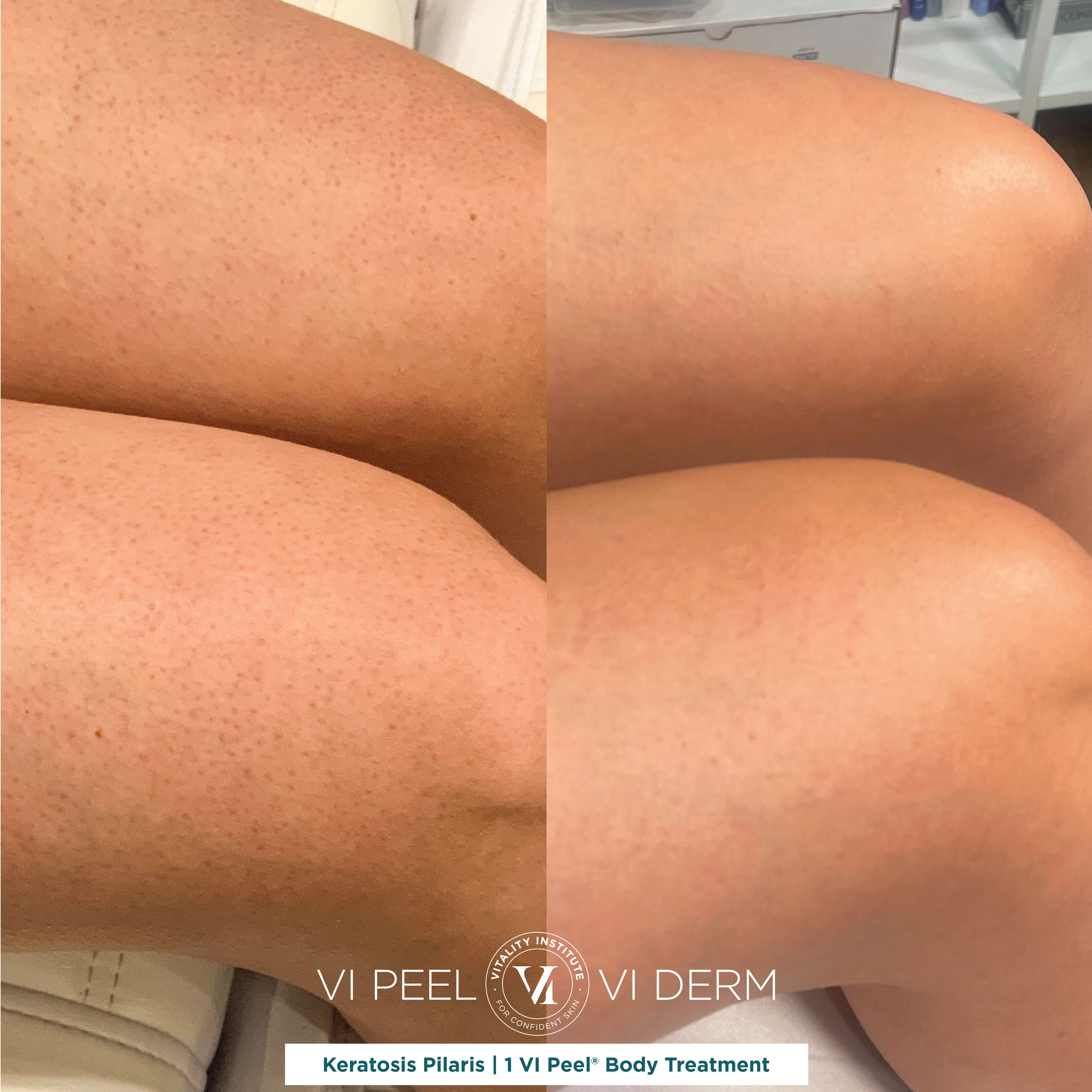 Keratosis Pilaris — Legs, 1 VI Peel Body Treatment