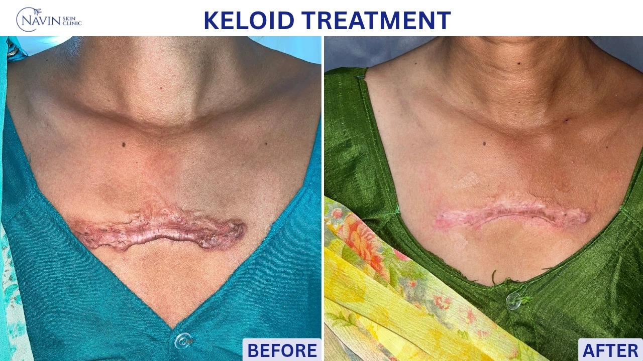 Keloid Treatment - Before