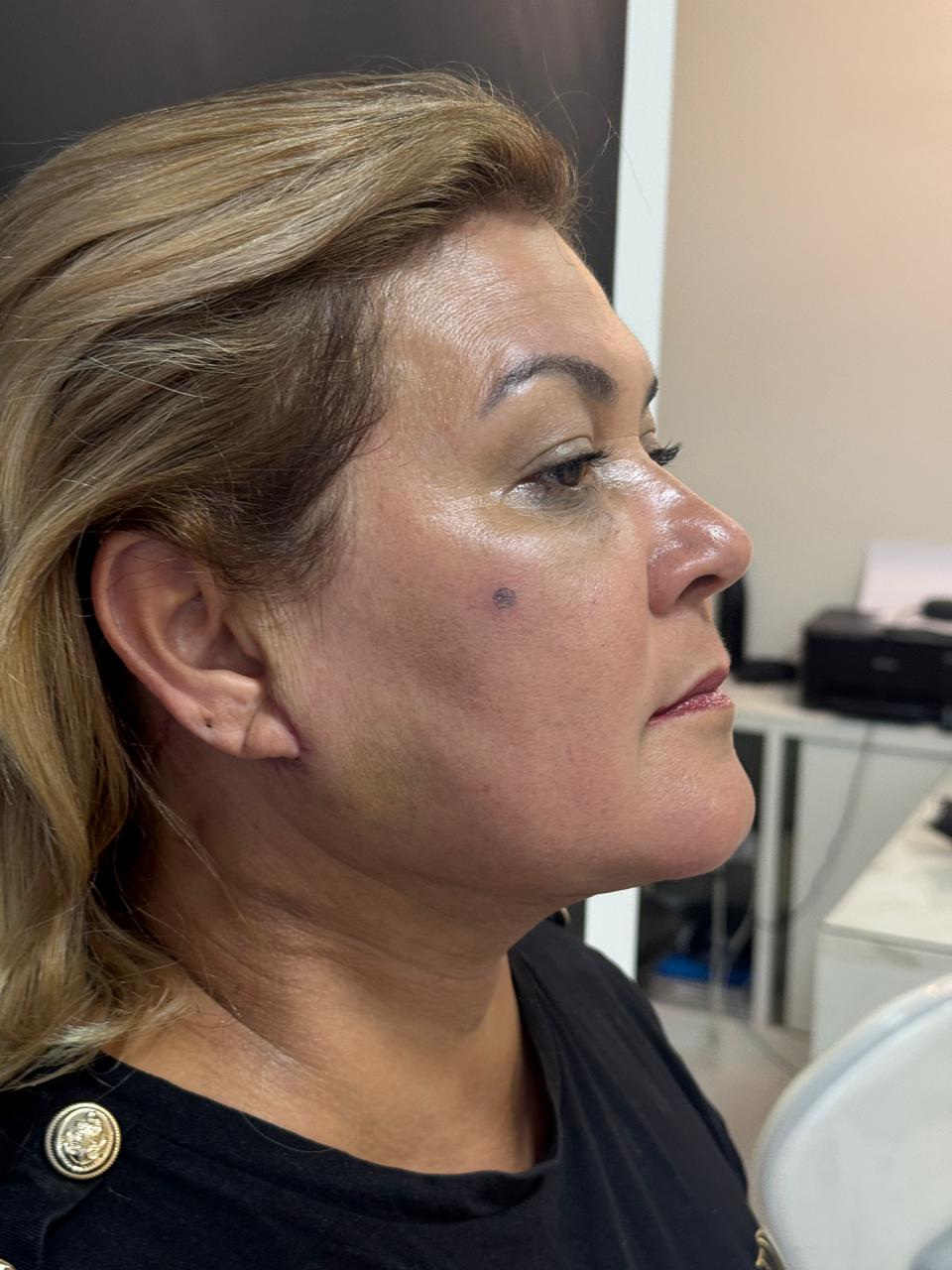 Depois da lipo de papada — vista frontal da paciente