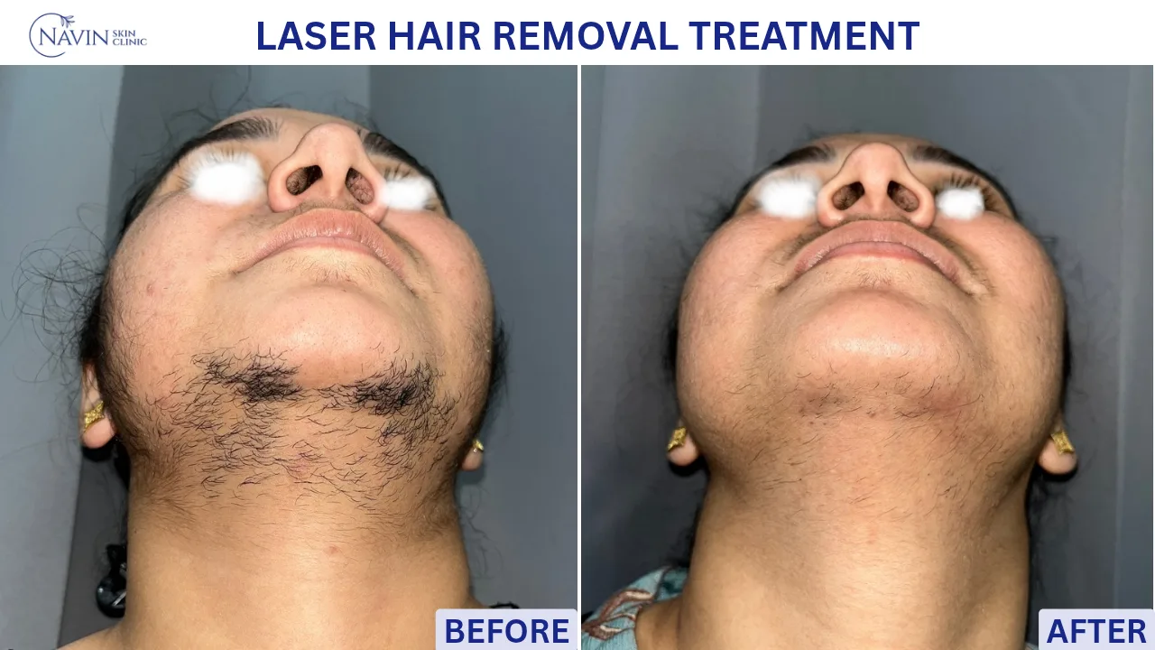 Laser Hair Removal Treatment - Before