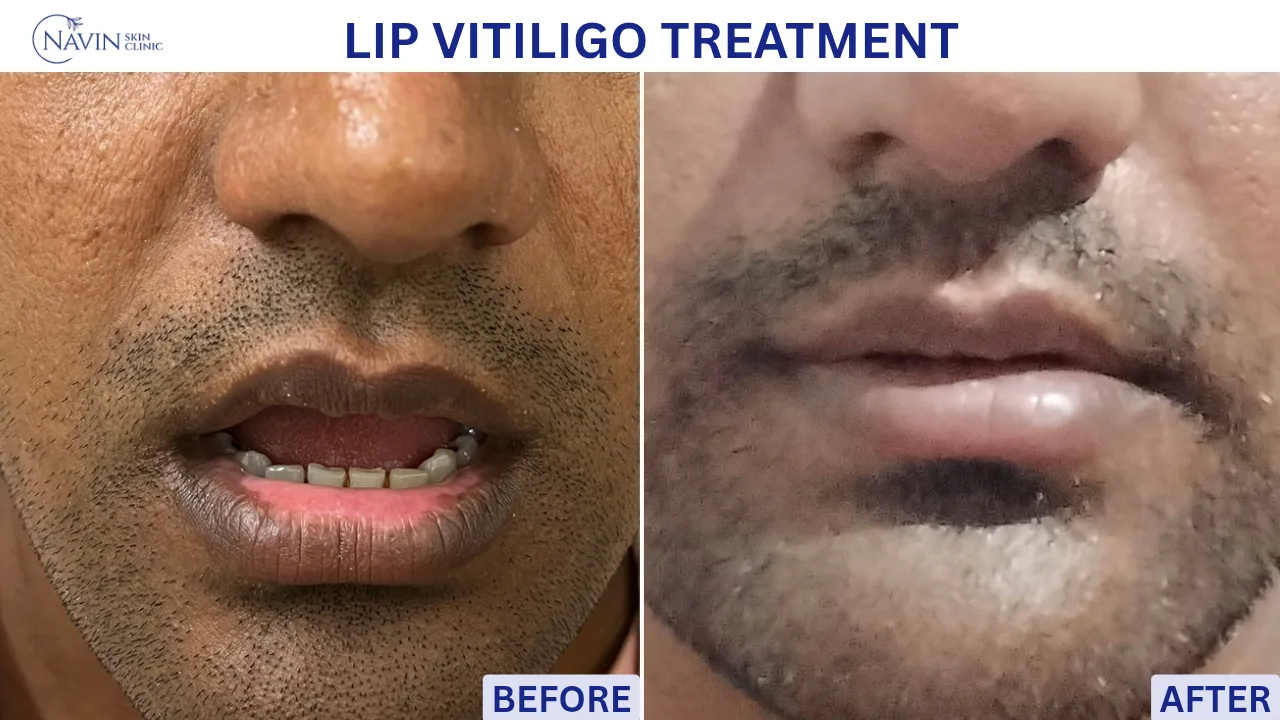 Lip Vitiligo Treatment - Before