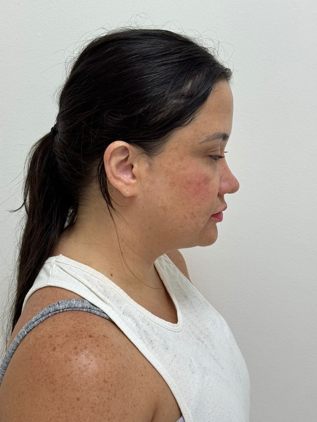Antes da lipo de papada com lifting cervical — perfil da paciente