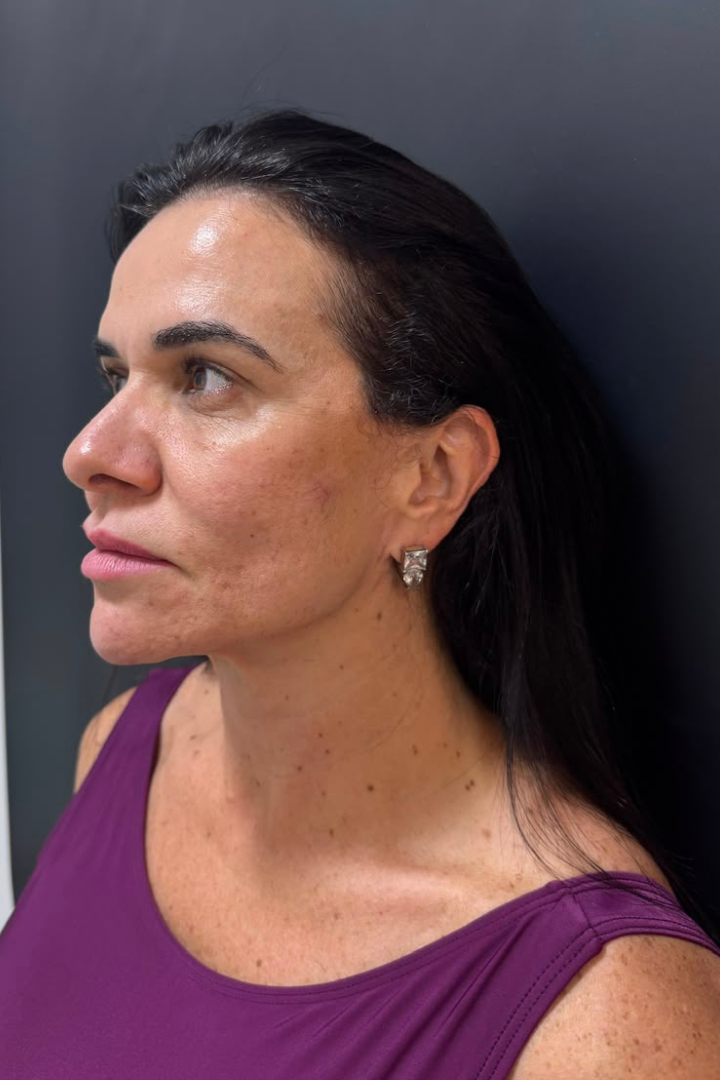 Antes do mini lifting — perfil da paciente
