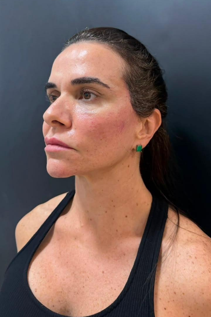 Depois do mini lifting — perfil da paciente