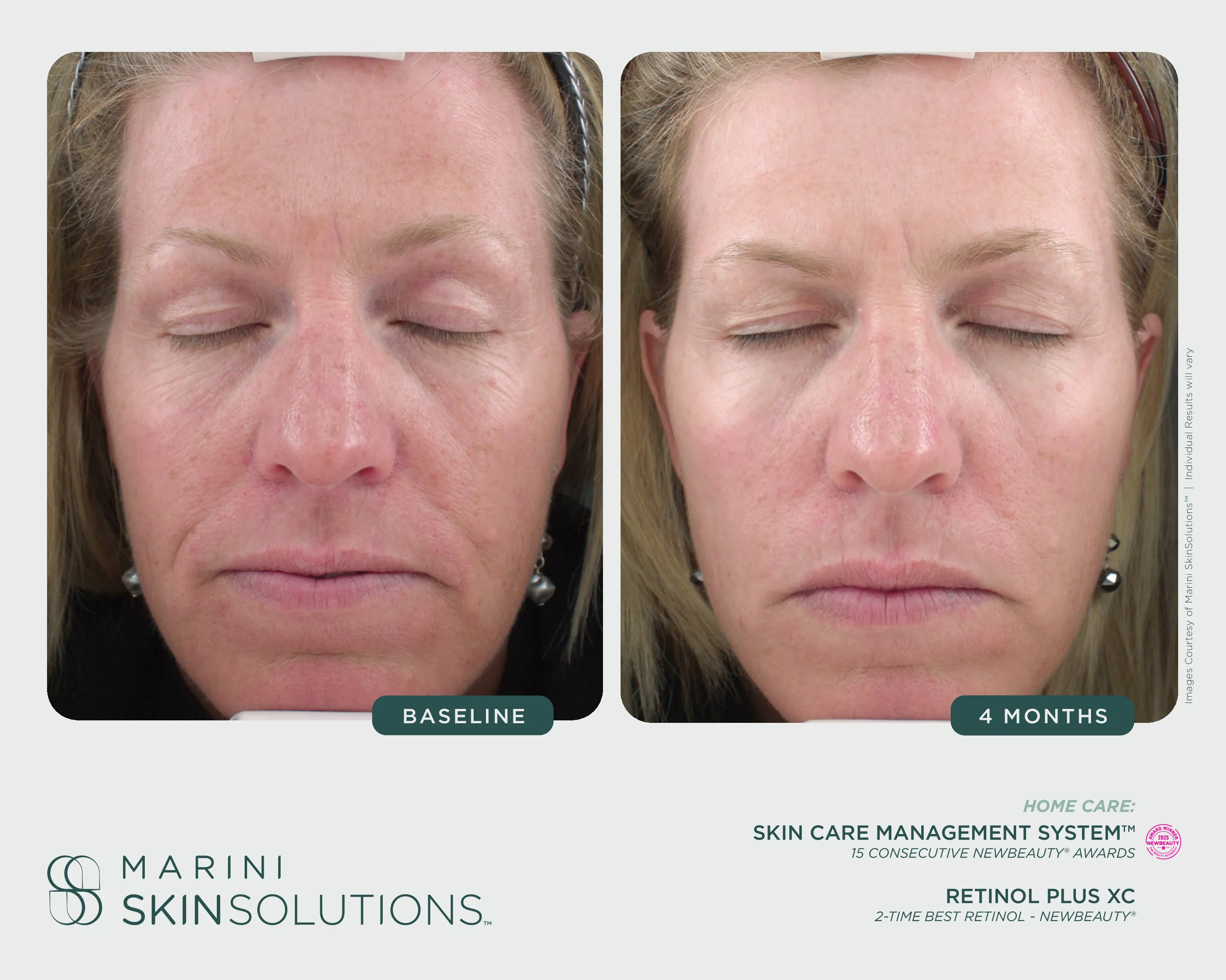 Wrinkles — SCMS + Marini Luminate XC, 2 Months