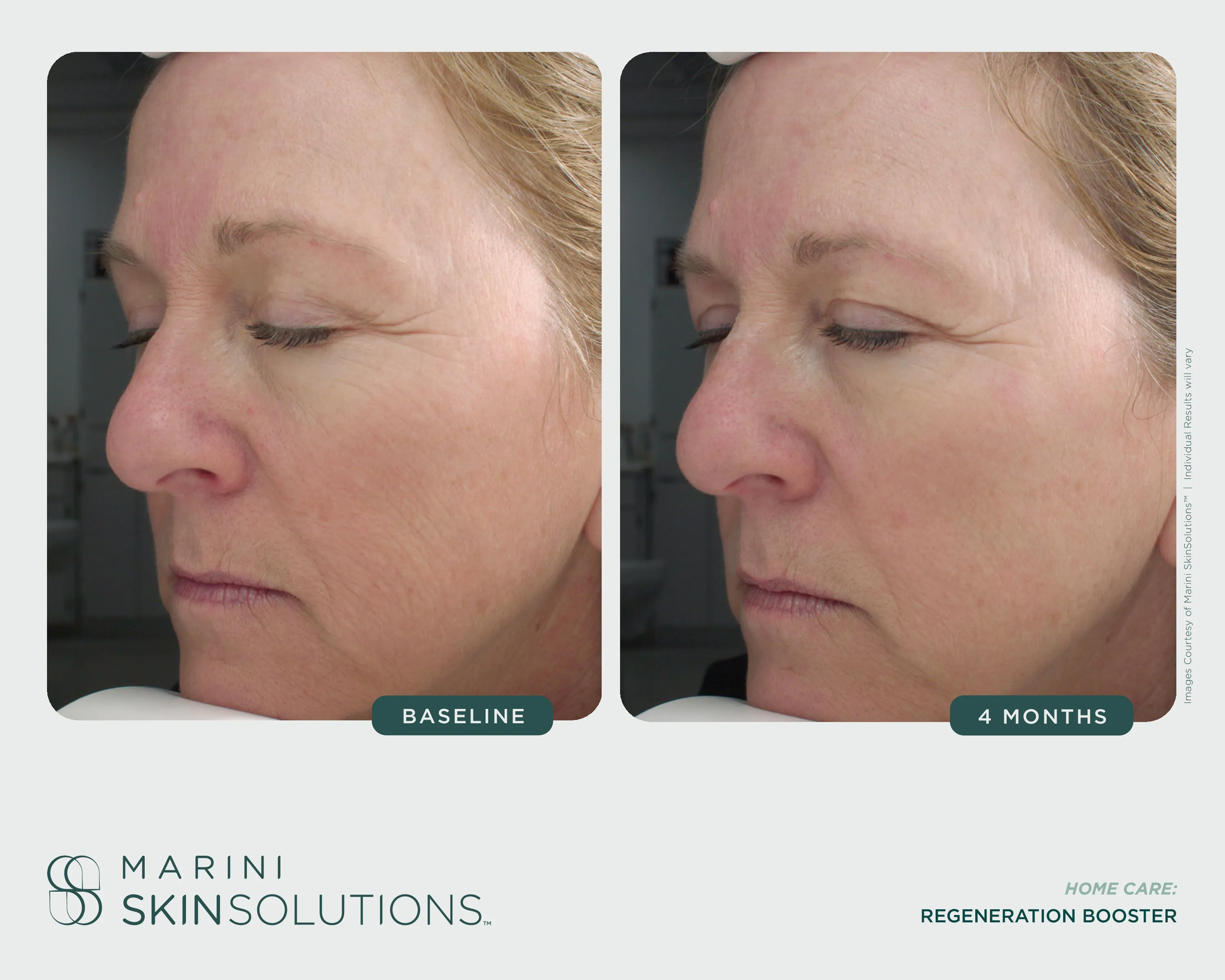 Wrinkles — SCMS + Regeneration Booster, 4 Months