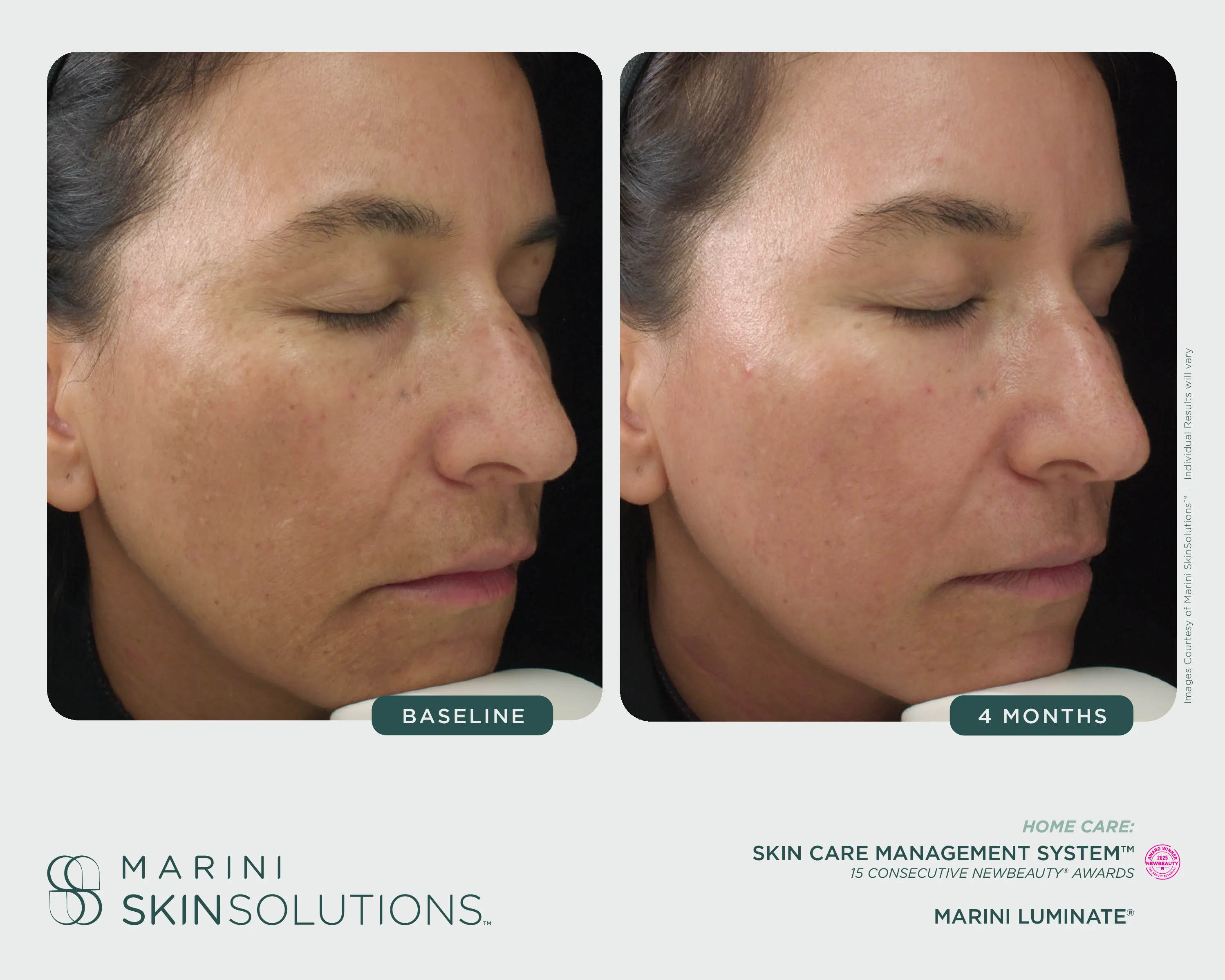 Discoloration — Clarify Peel + SCMS + Marini Luminate