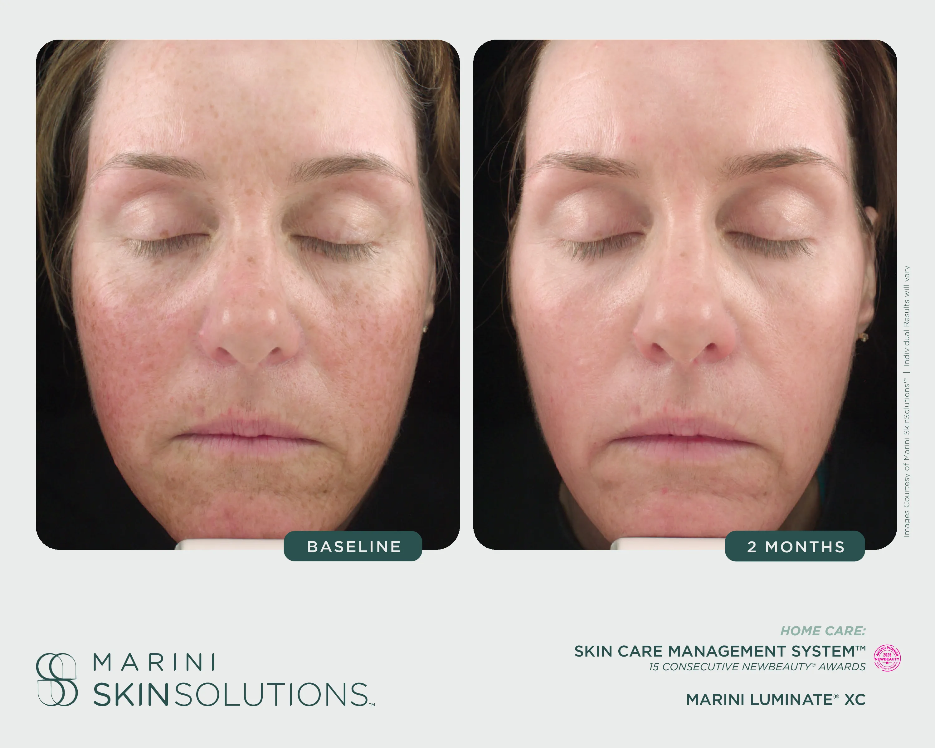Redness — Laser Treatment + SCMS + Rosalieve