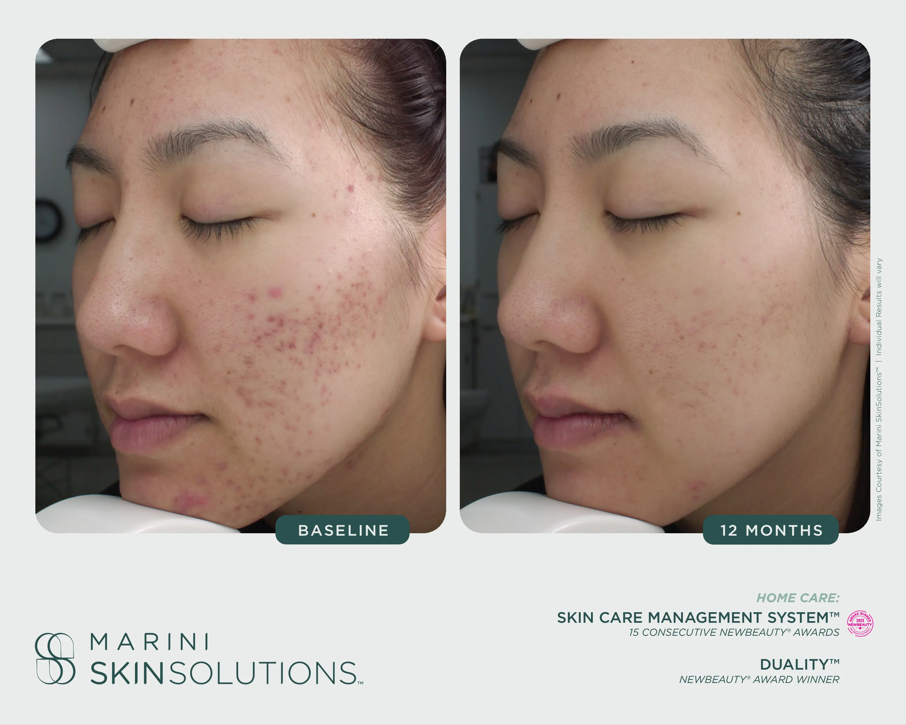 Discoloration — Transform Peel + SCMS + Retinol Plus XC