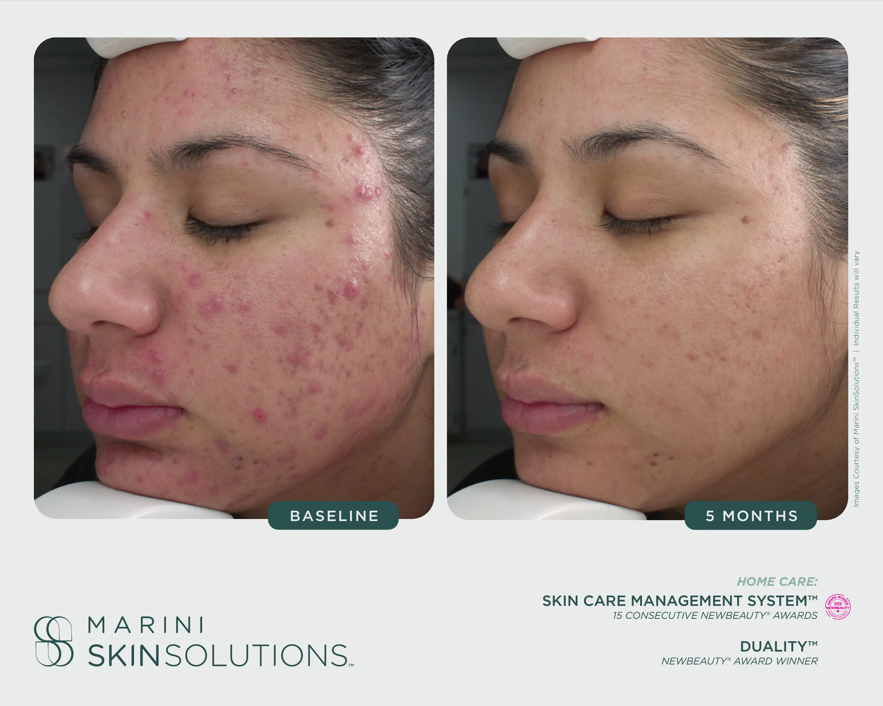 Hand — Resurfacing Gel + Retinol Plus Mask + Marini Renu