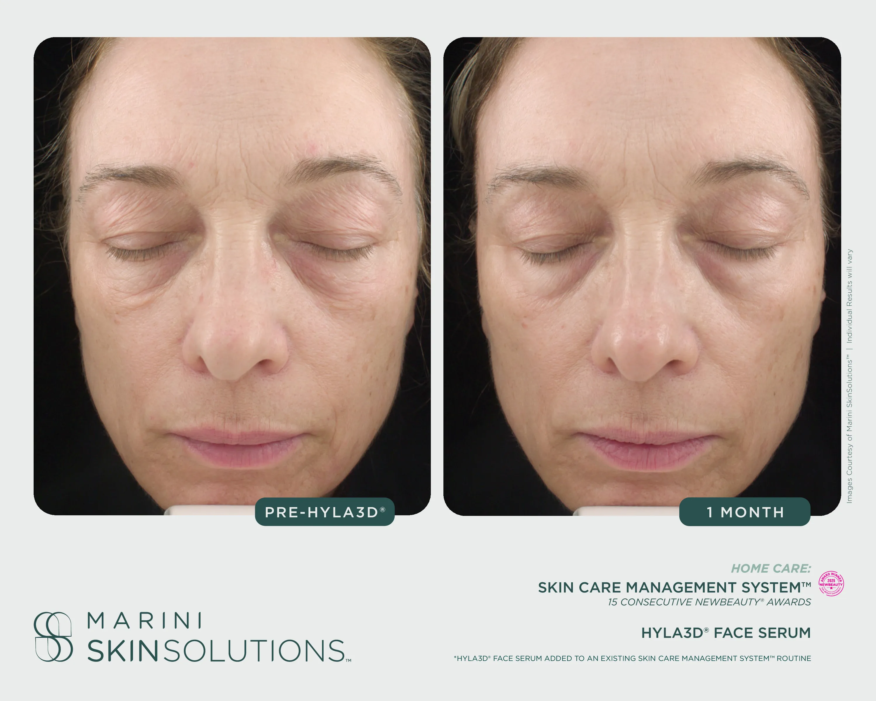 Acne — SCMS + Duality, 5 Months