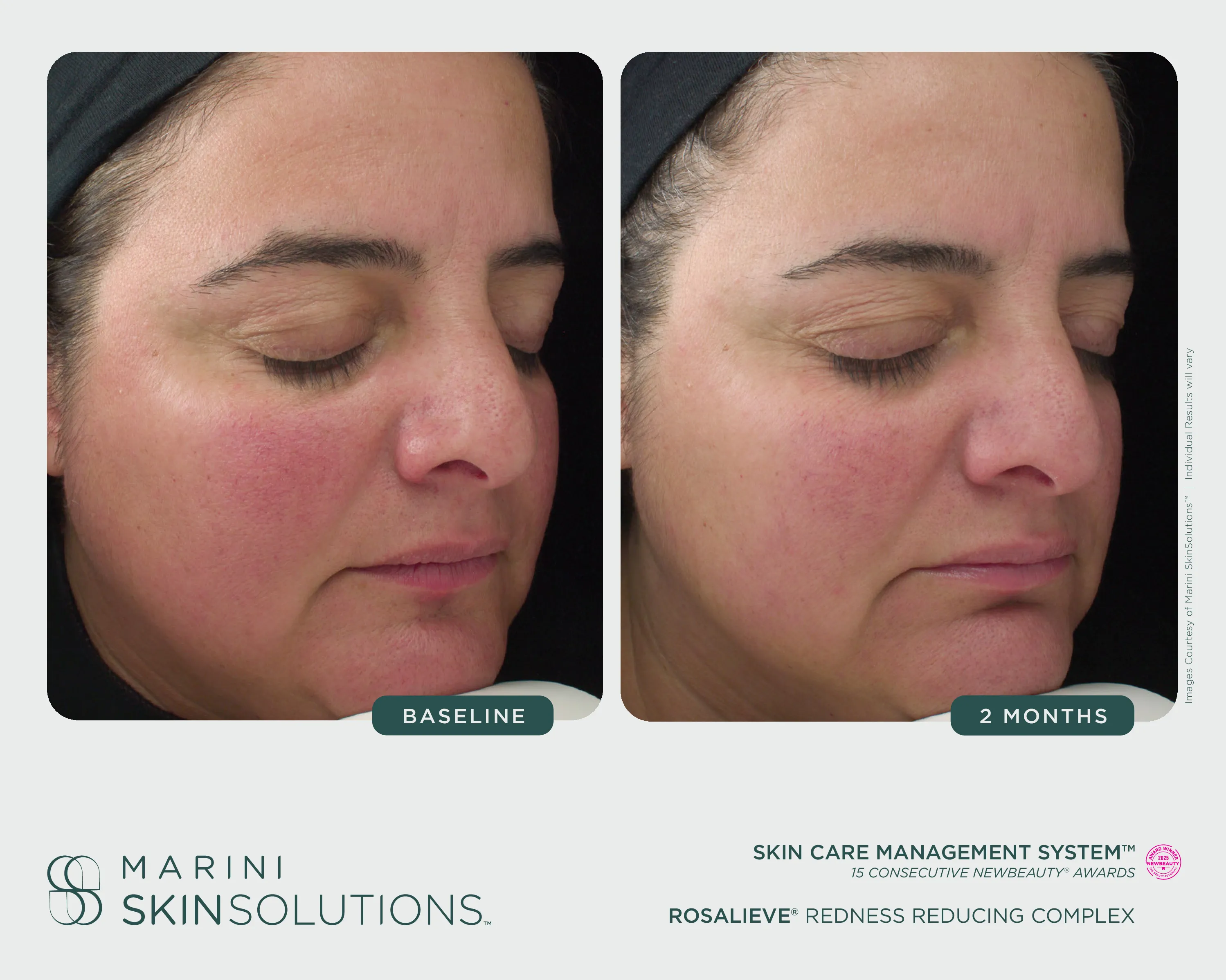 Redness — Transform Peel + Marini Renu Hand Complex