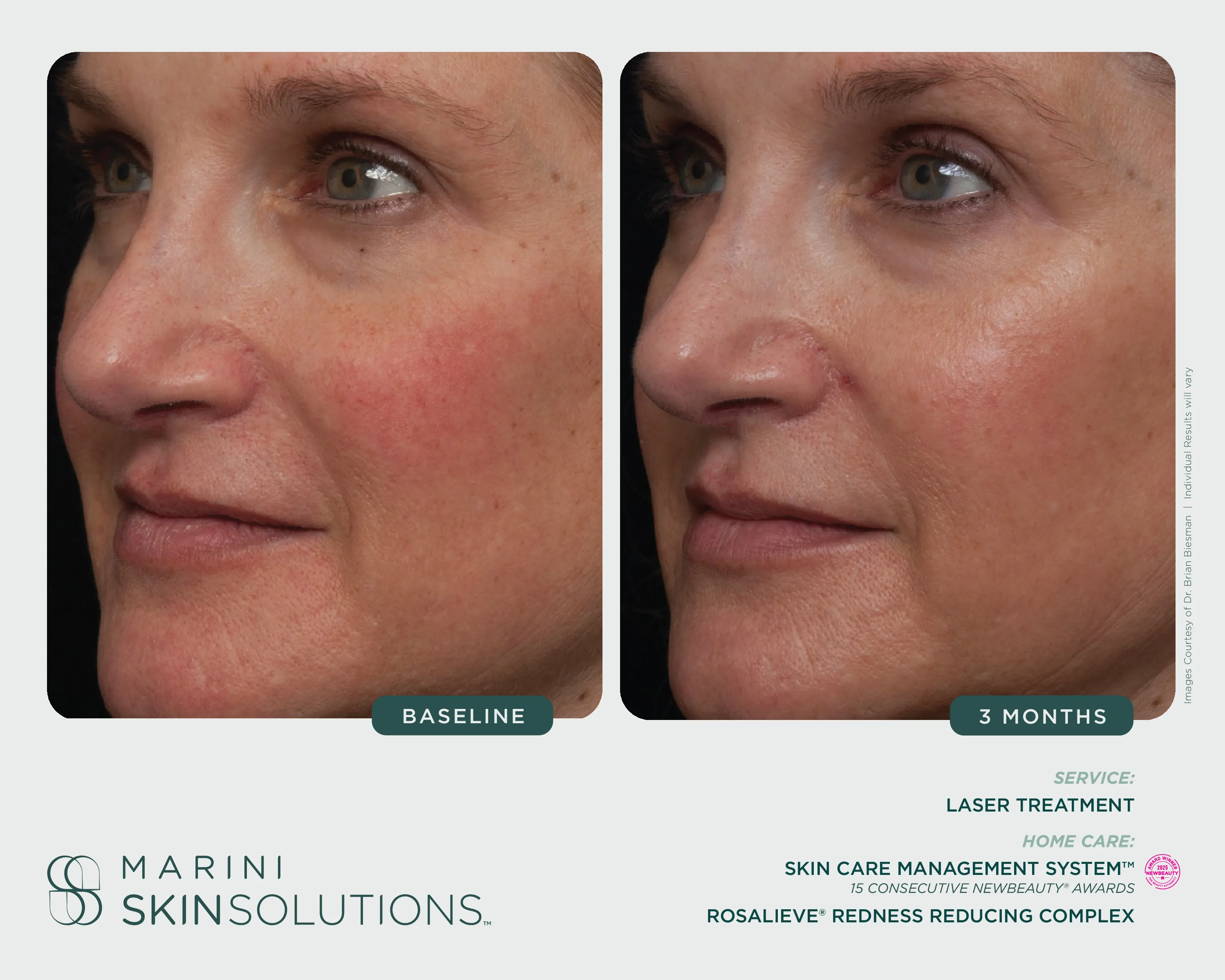Volume & Wrinkles — SCMS + Hyla3D Face Serum, 1 Month