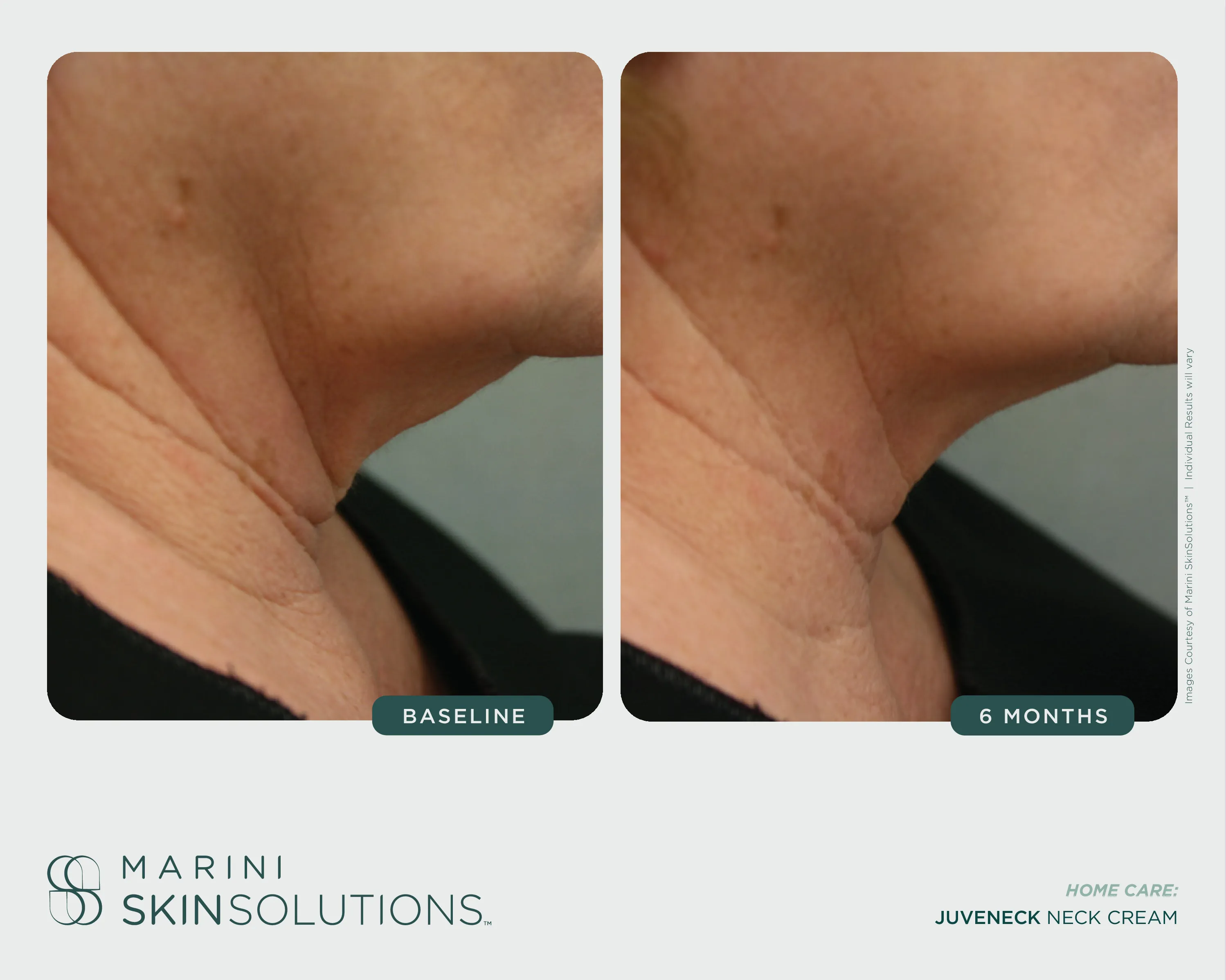 Neck — SCMS + Juveneck Neck Cream, 6 Months (II)
