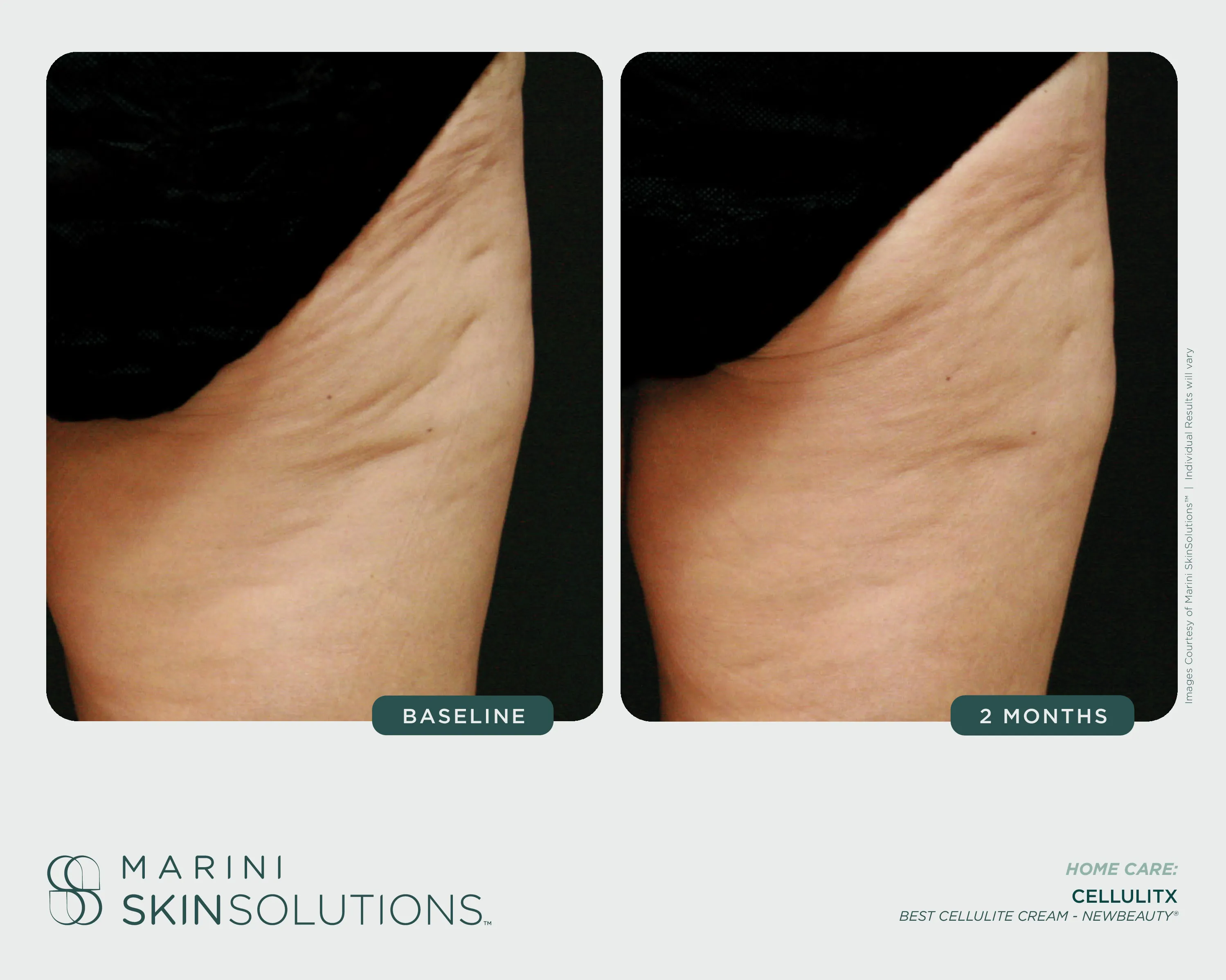 Acne — Skin Care Management System + Duality, 12 Months