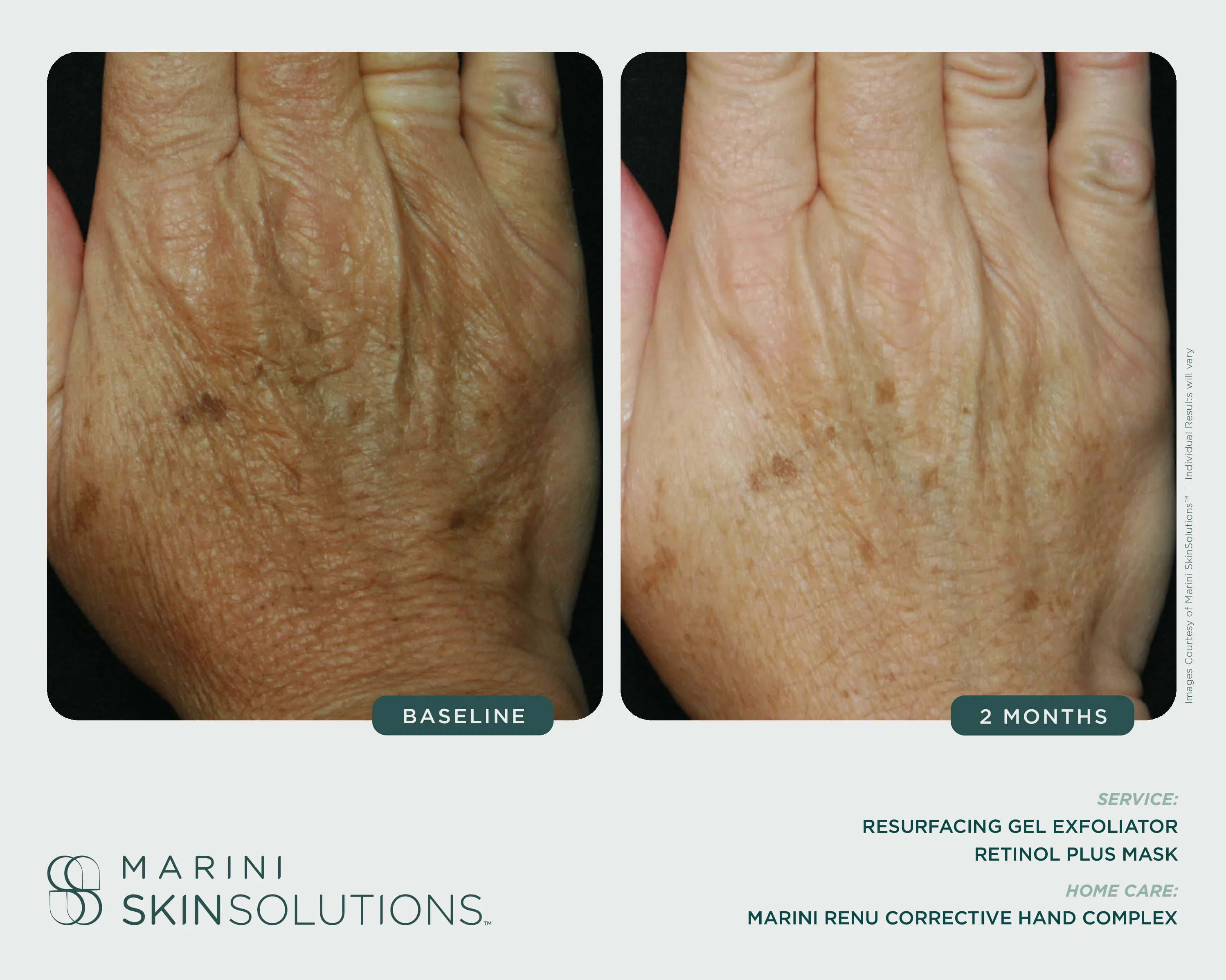 Wrinkles — SCMS + Retinol Plus XC, 4 Months