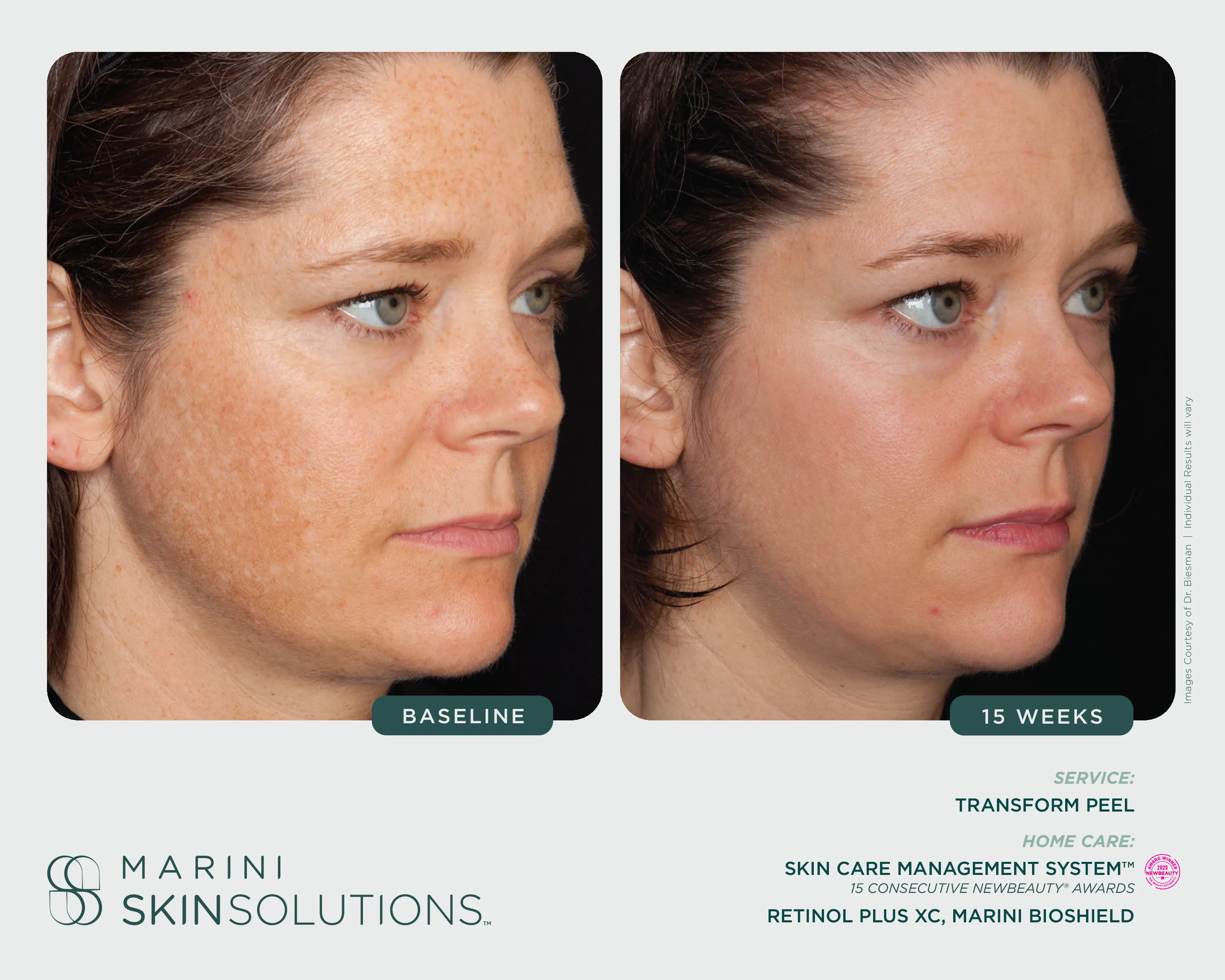 Pigmentation — SCMS + Marini Luminate, 4 Months