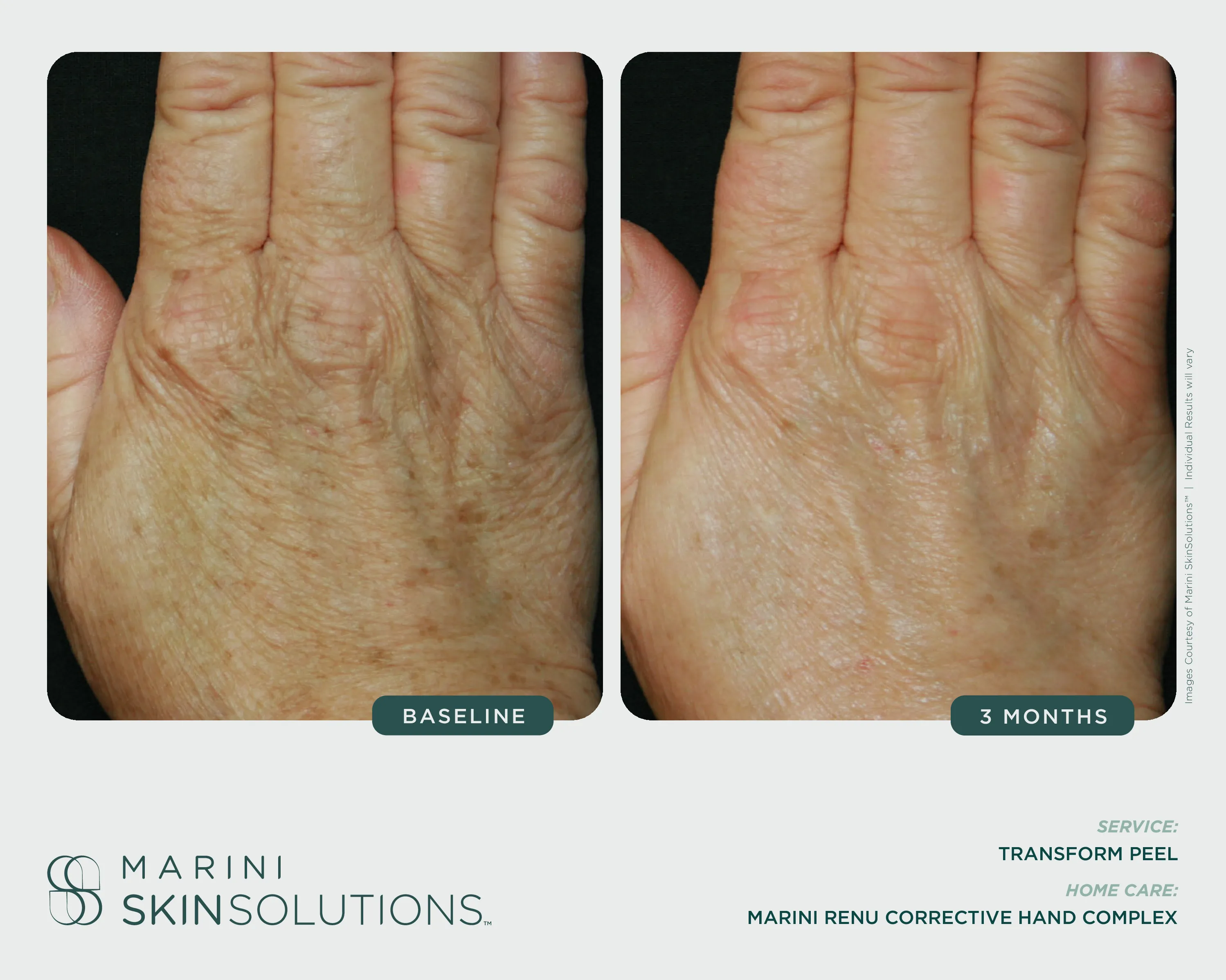 Body — CellulitX, Baseline vs 1 Month