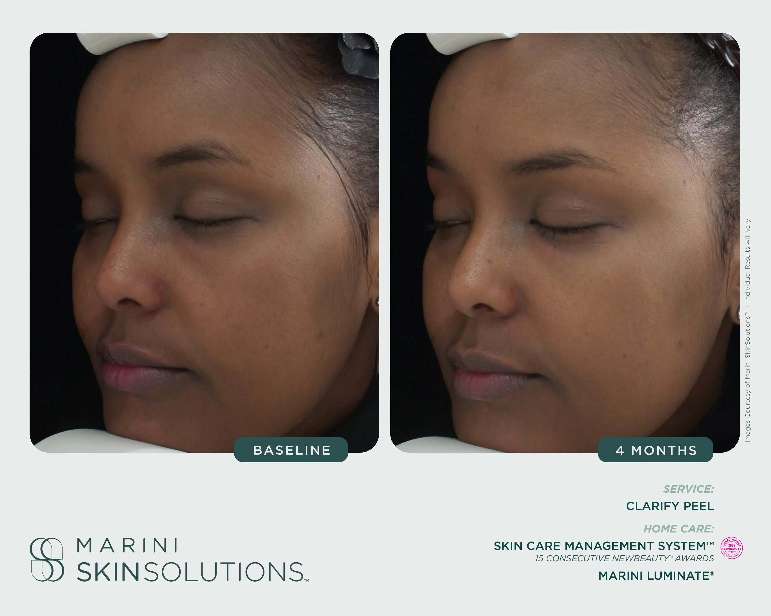 Redness — SCMS + Rosalieve Redness Reducing Complex