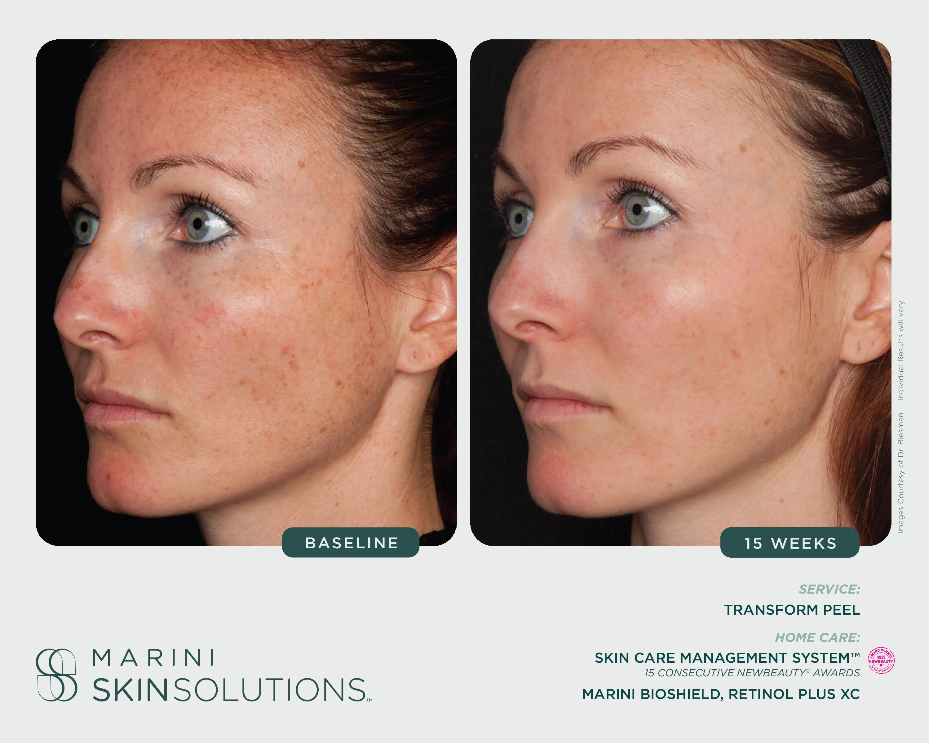 Discoloration — Transform Peel + SCMS + Marini Bioshield + Retinol Plus XC, 15 Weeks
