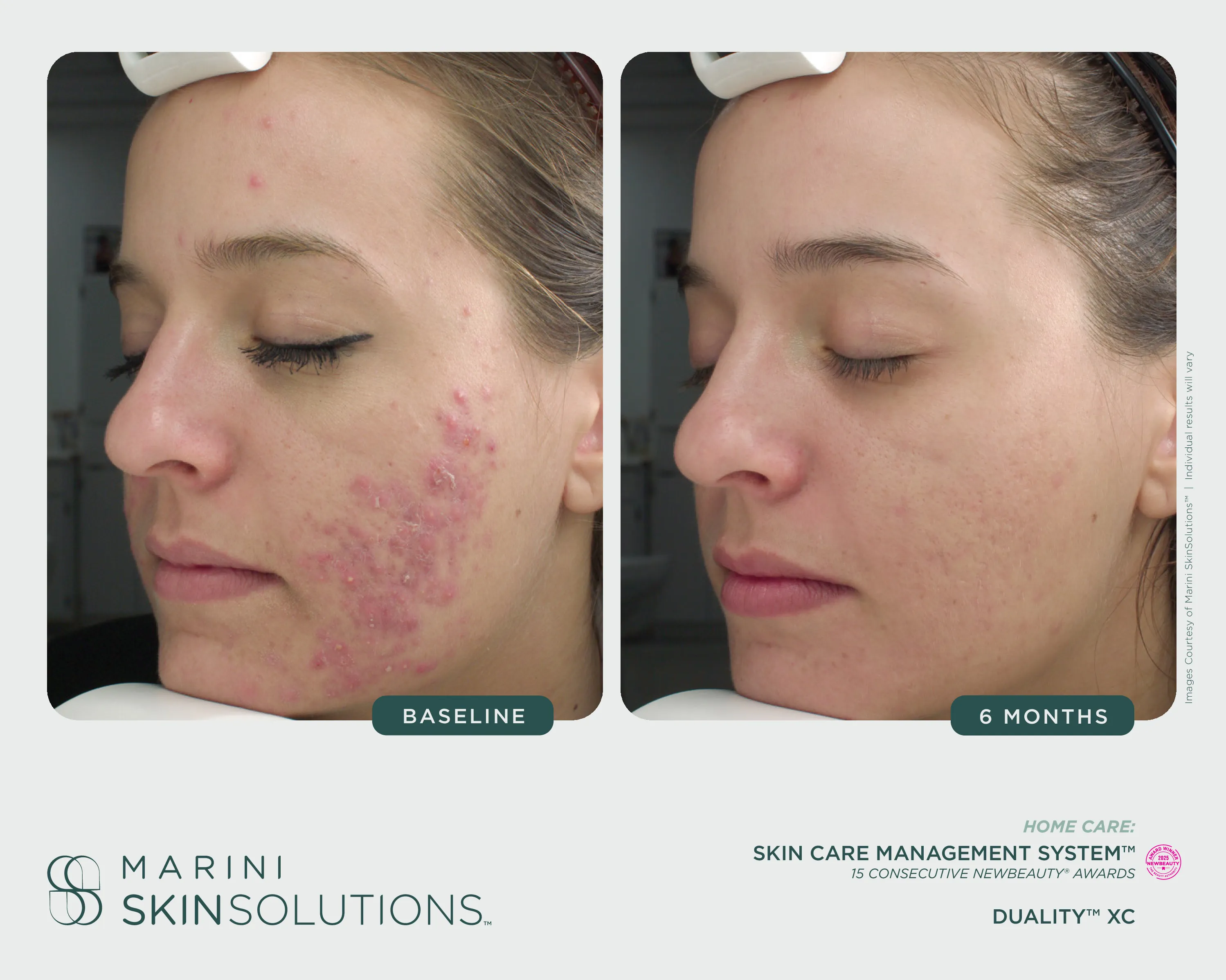 Acne — SCMS + Duality XC, 6 Months