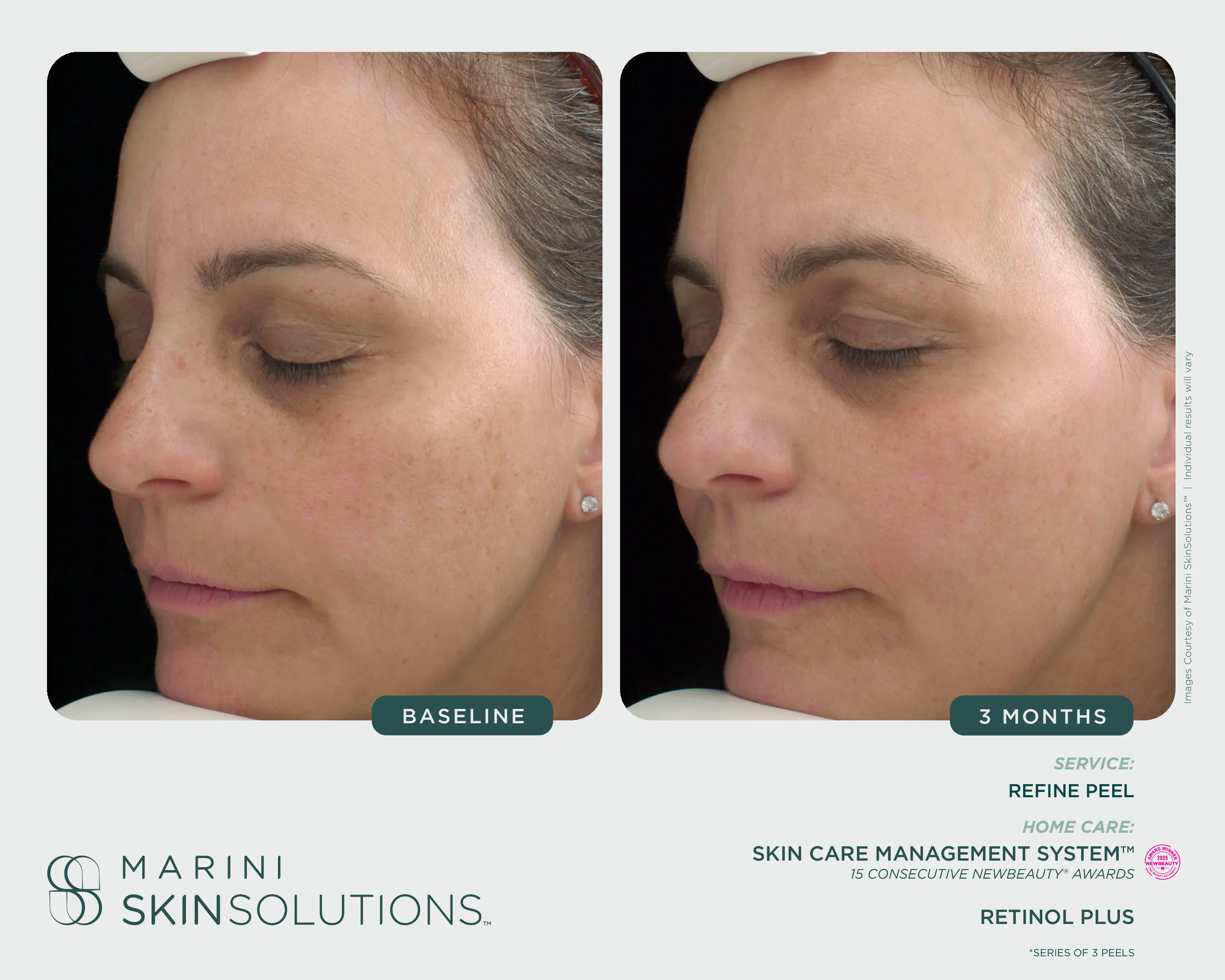 Peel — Refine Peel (Series of 3) + SCMS + Retinol Plus, 3 Months