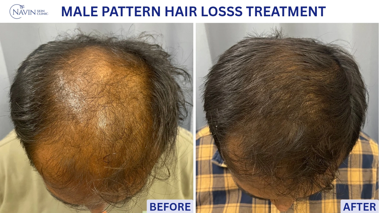 Male Pattern Hair Loss Treatment - Before