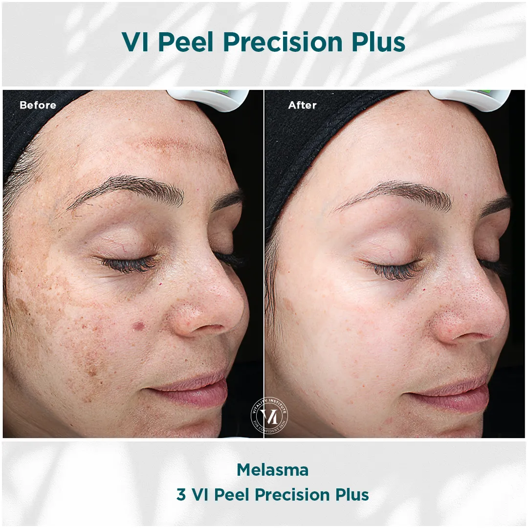 Melasma — 3 VI Peel Precision Plus