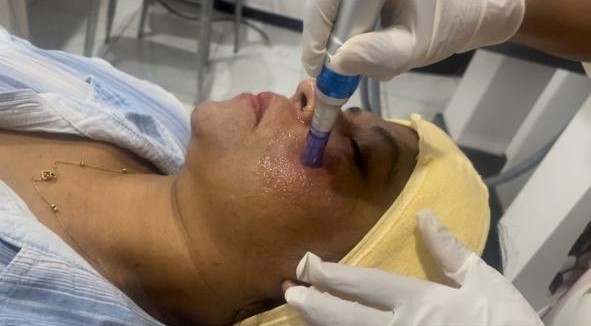 Microneedling - Professional aesthetic treatment at The Elite Derma Care, Nugegoda