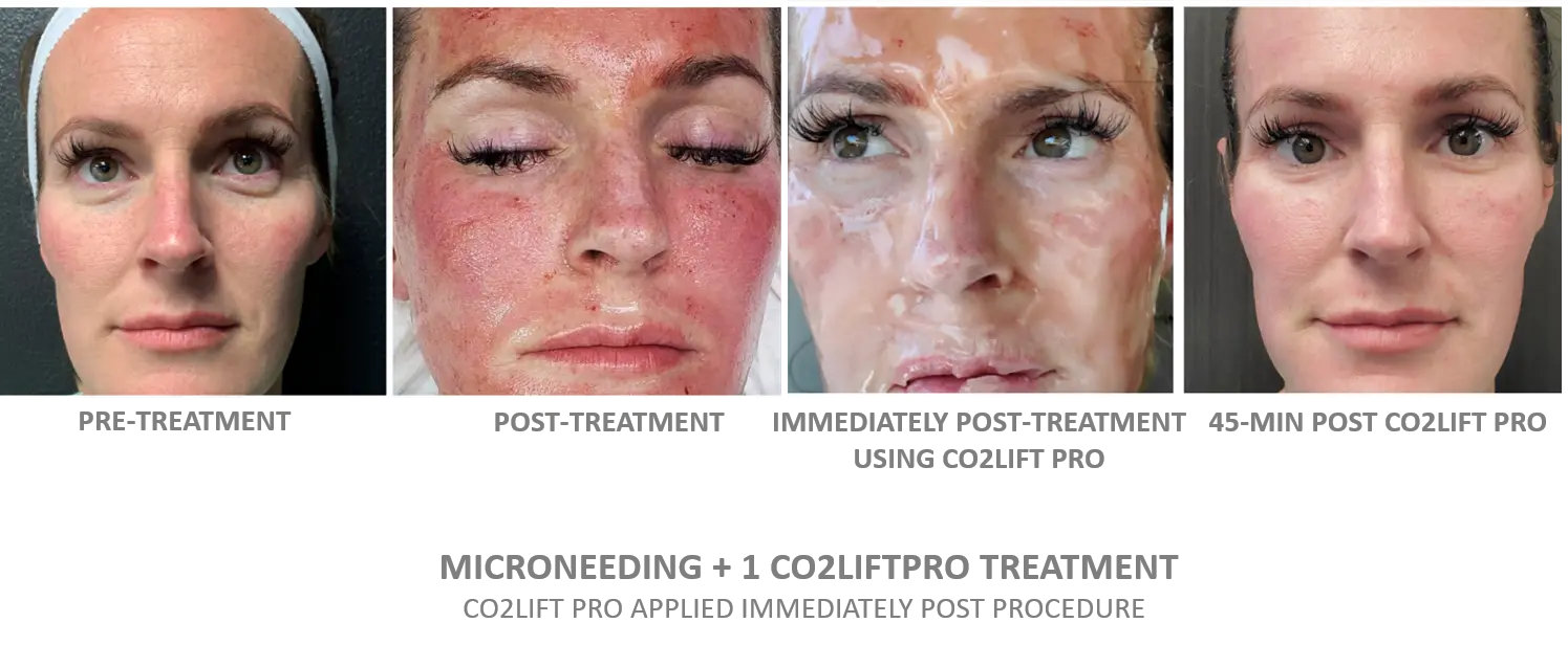 Microneedling + CO2Lift Pro