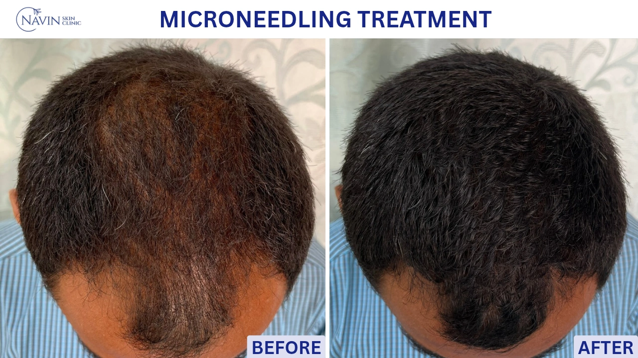 Microneedling Treatment - Before
