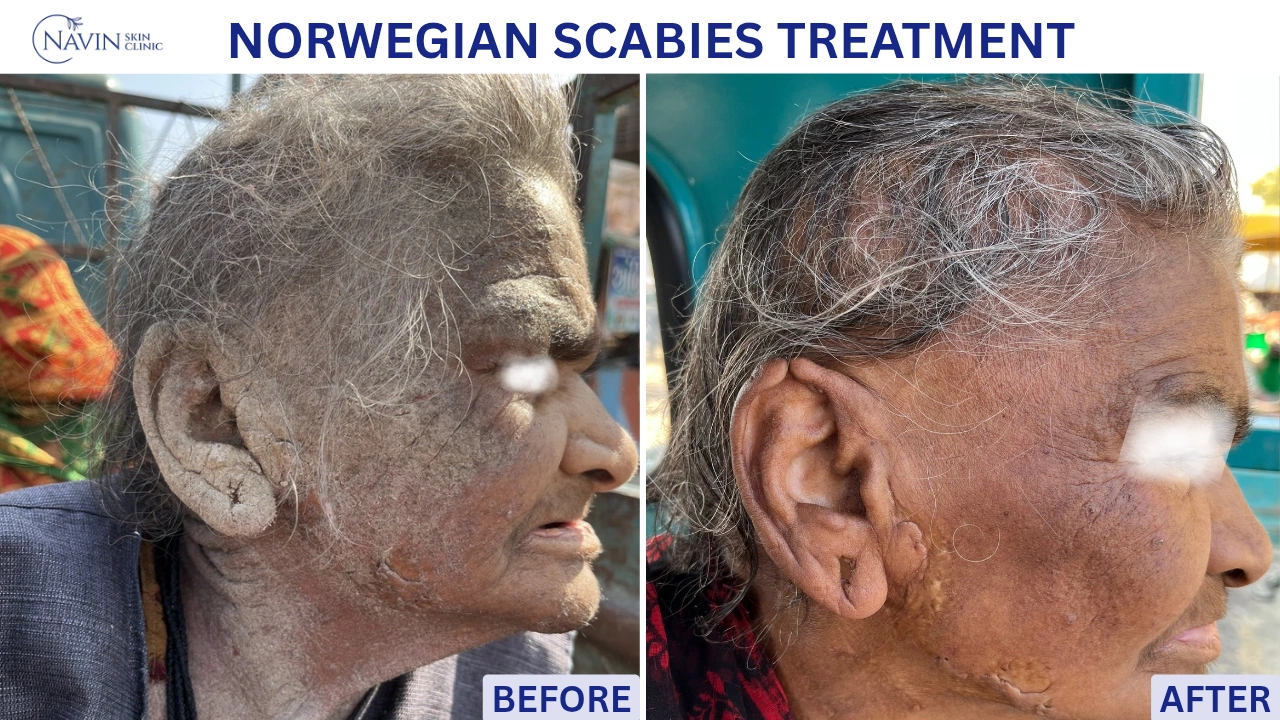 Norwegian Scabies Treatment - Before