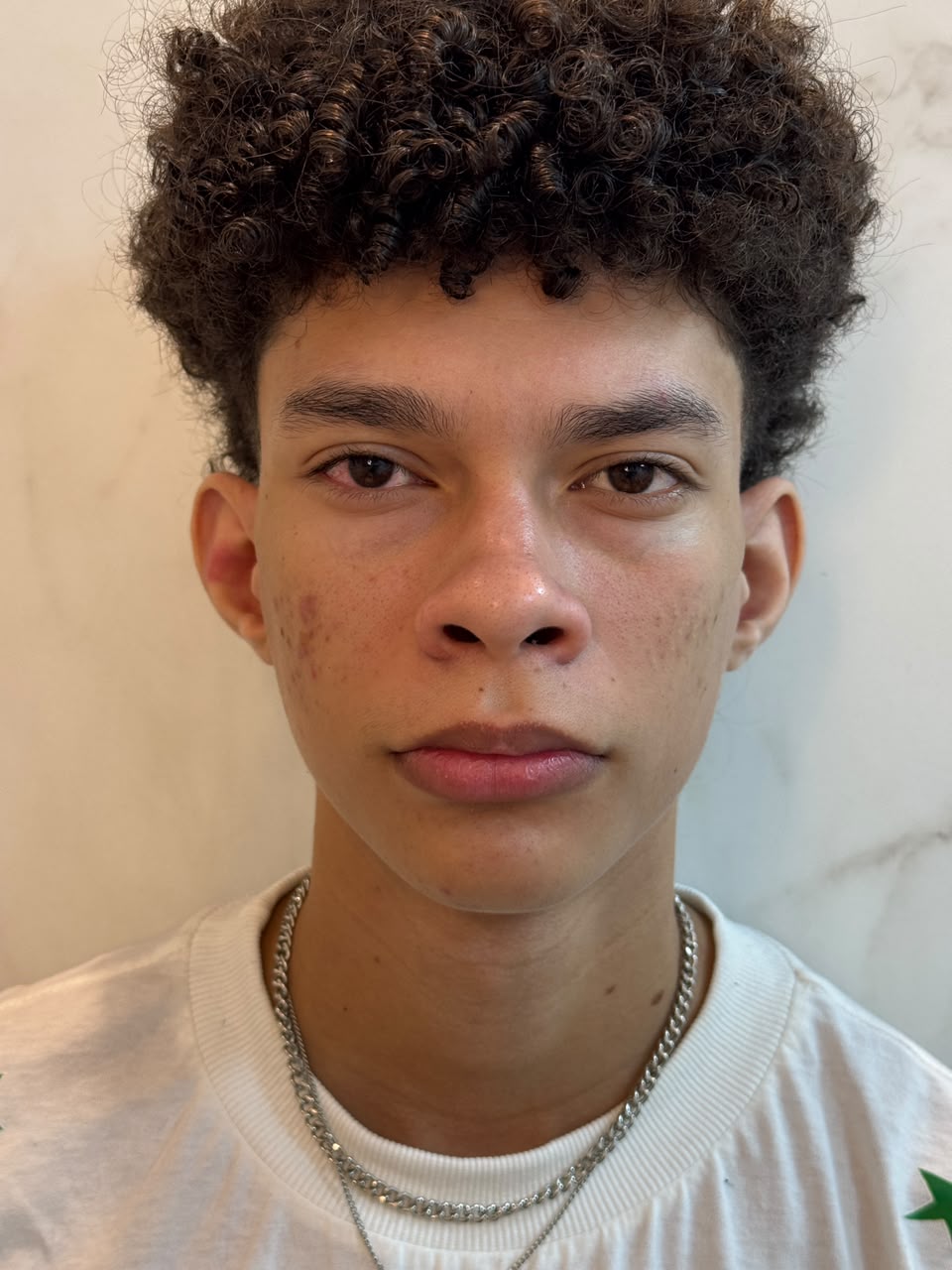 Antes da otoplastia — paciente antes do procedimento
