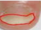 Onycholisis