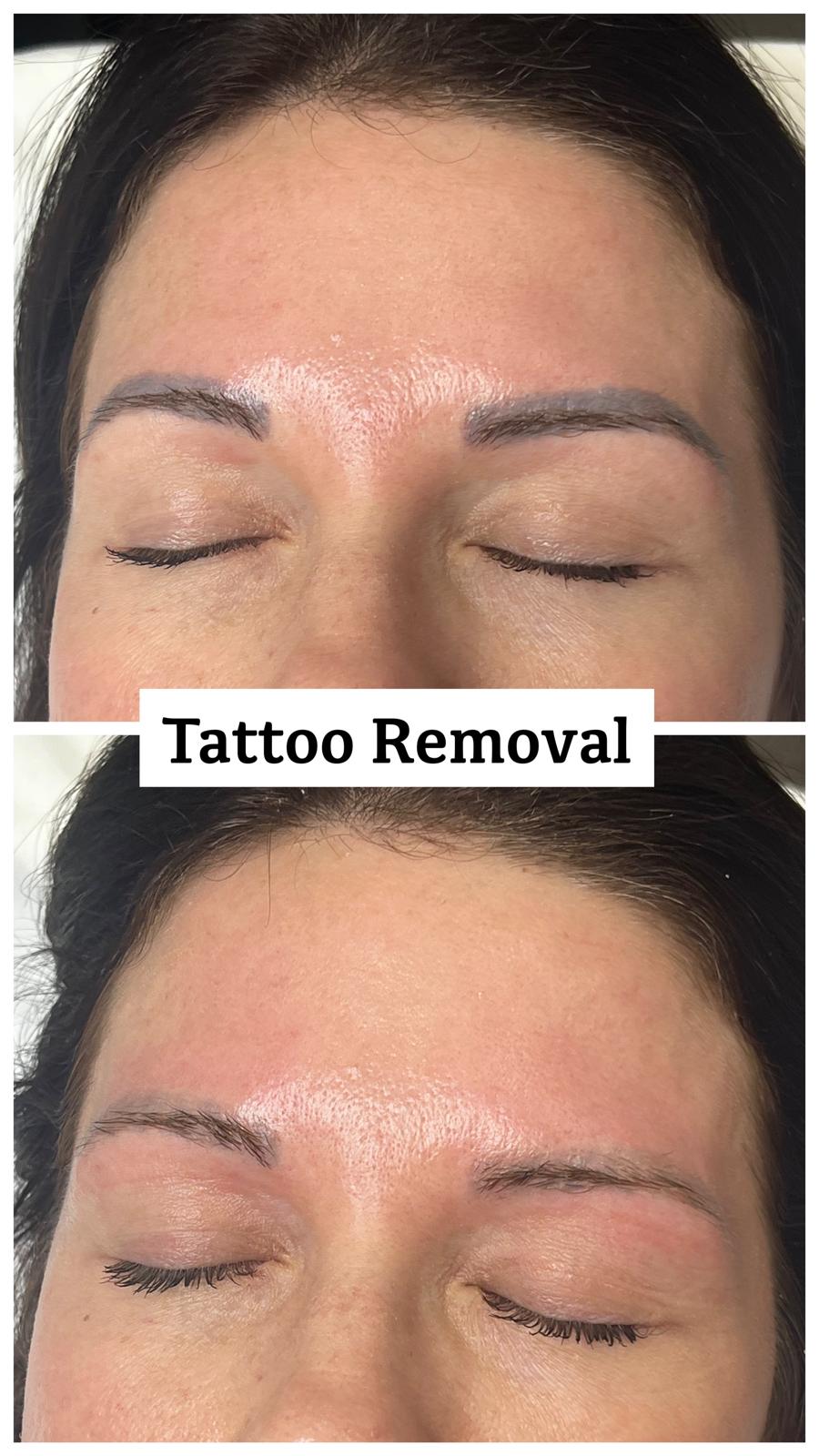 Tattoo removal before and after results using PicoLight picosecond laser - cosmetic eyebrow tattoo fading on facial skin