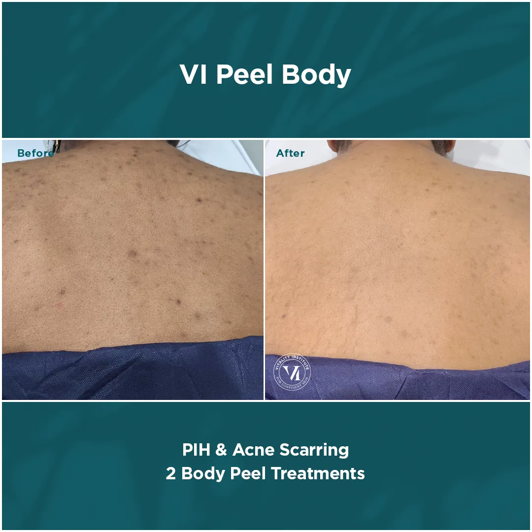 PIH & Acne Scarring — Back, 2 VI Peel Body Treatments