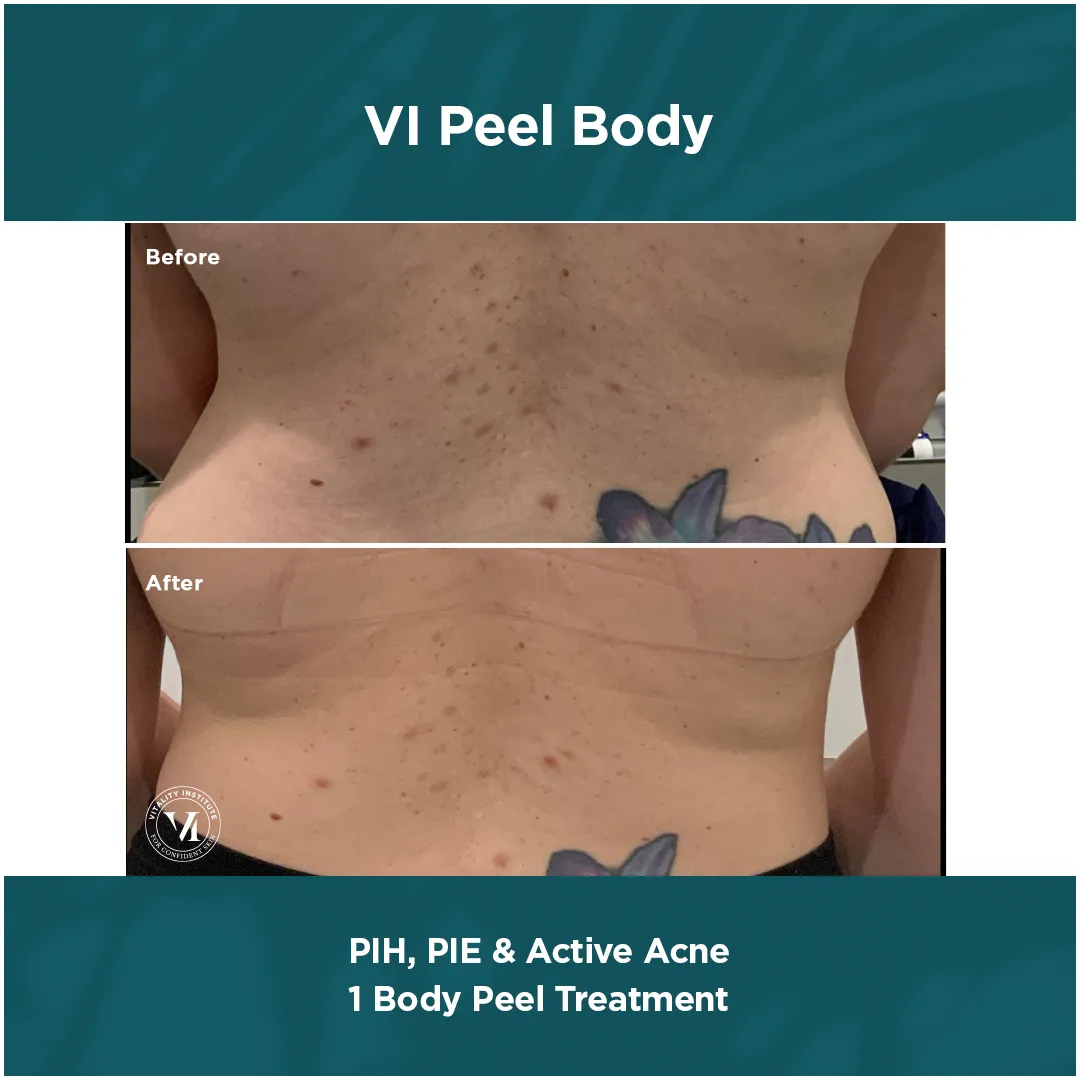 PIH, PIE & Active Acne — 1 VI Peel Body Treatment
