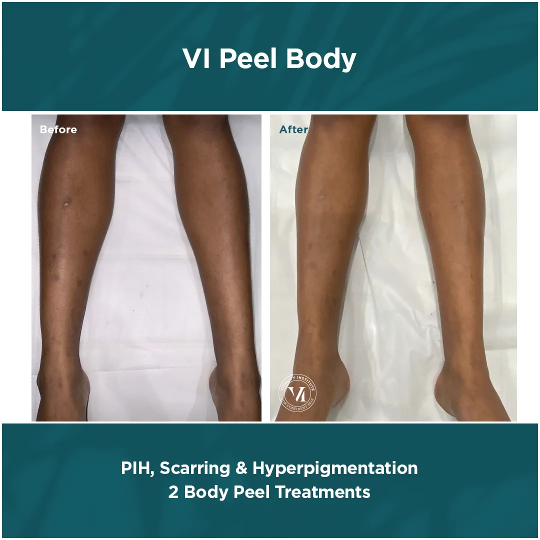 PIH, Scarring & Hyperpigmentation — Legs, 2 VI Peel Body Treatments