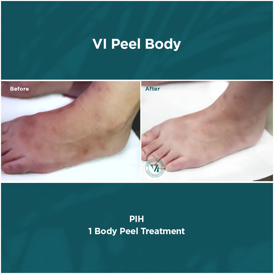 PIH — Foot & Ankle, 1 VI Peel Body Treatment