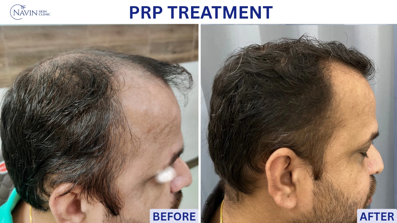 PRP Treatment - Before