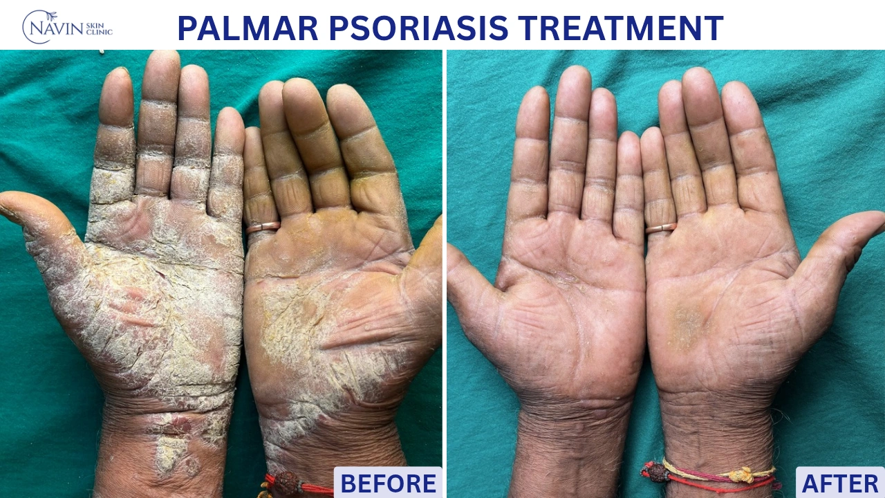 Palmar Psoriasis Treatment - Before