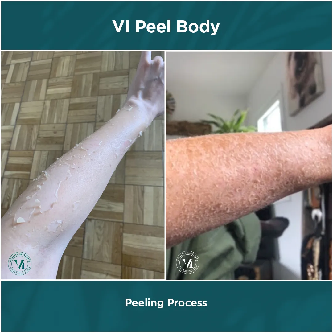 Peeling Process — Forearm, Dual Panel