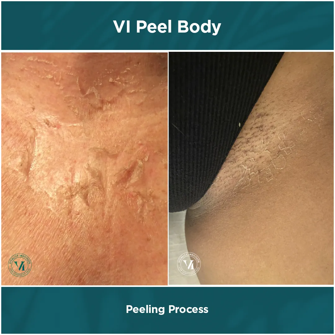 Peeling Process — Close-Up Dual Panel
