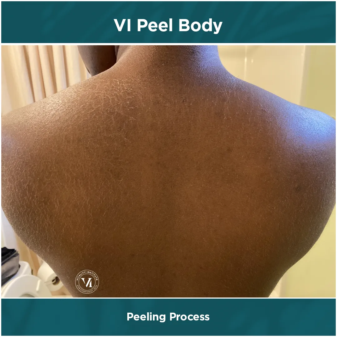 Peeling Process — Deep Skin Tone, Full Back